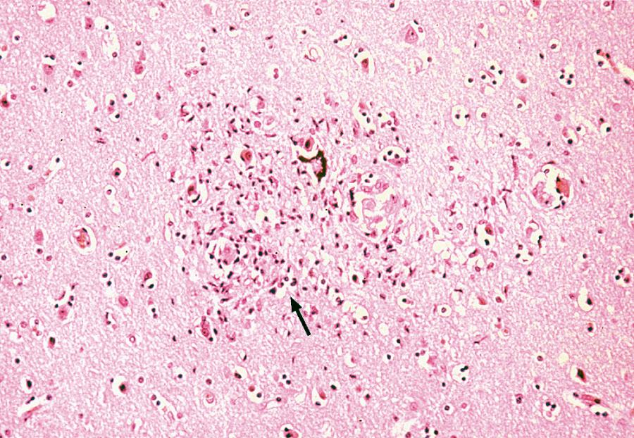 Fig. 77.2, Human Immunodeficiency Virus Encephalitis. Microglial nodule (arrow) containing multinucleated giant cells. (H&E, ×200.)