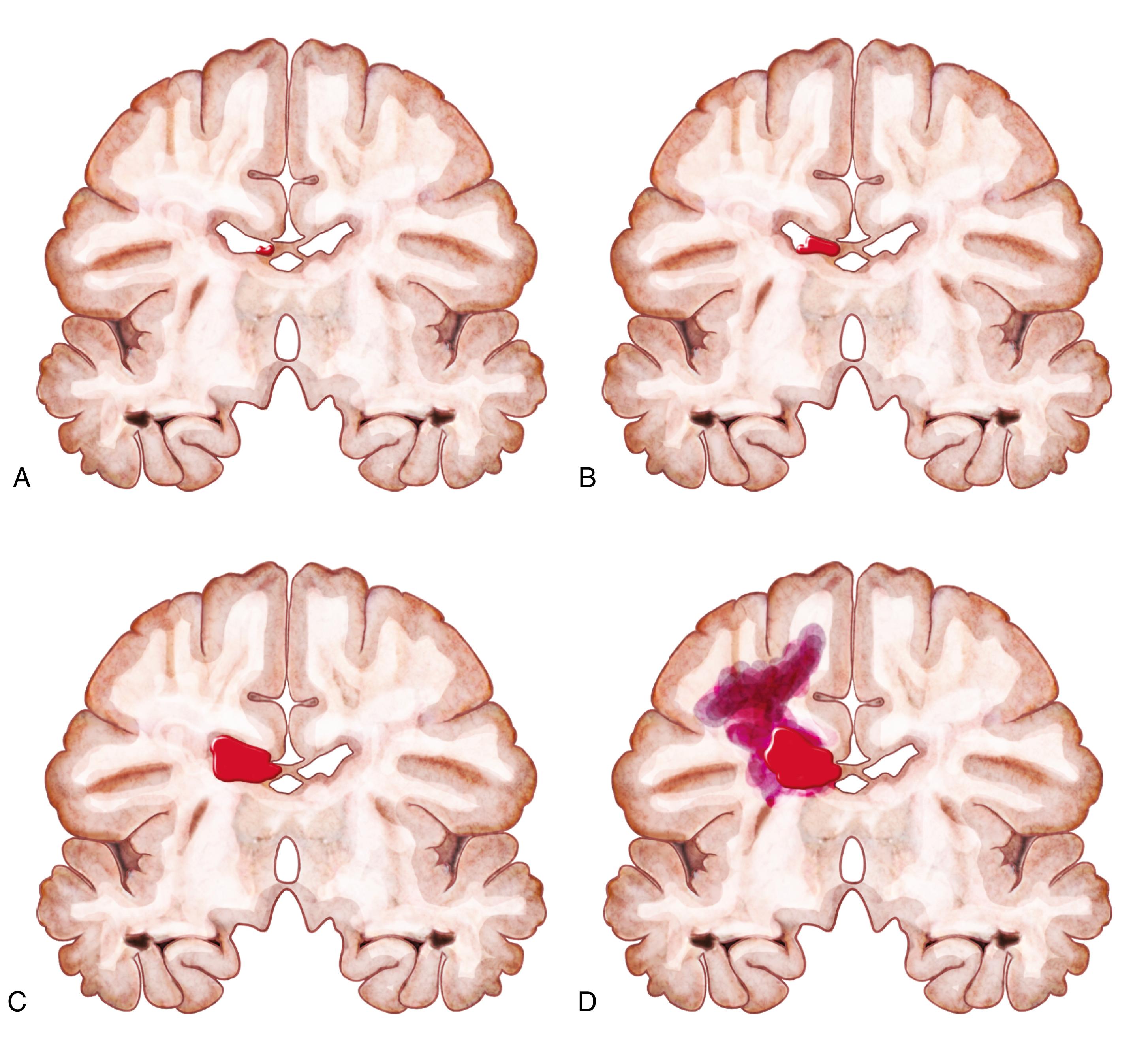 Fig. 110.7, The Progressive Grades of Intraventricular Hemorrhage From Mildest to Most Severe. (A) Grade I hemorrhage involves less than 10% of the ventricular volume of the lateral ventricles. (B) Grade II involves 10%–50% of the ventricular volume. (C) Grade III involves more than 50% of the ventricular volume and is frequently associated with ventricular dilatation. (D) Hemorrhage is associated with periventricular hemorrhagic infarction.