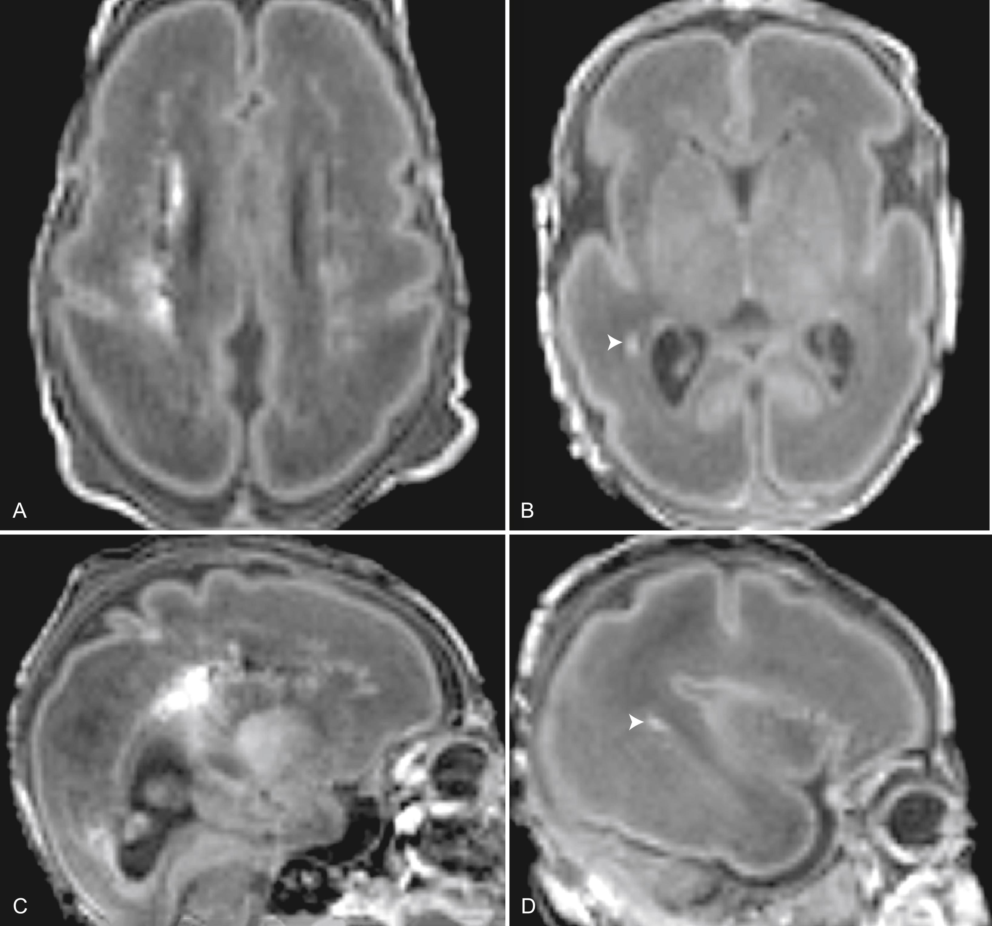 Fig. 110.8, Different Severities of White Matter Injury in the Preterm Neonate. (A and C) Appearance of cystic necrotic white matter injury on magnetic resonance imaging (MRI). Small areas of cavitation are appreciated as hypointensity on the sagittal T1-weighted image. (B and D) Punctate white matter injury on MRI has the appearance of signal hyperintensities on T1 (arrowheads) .