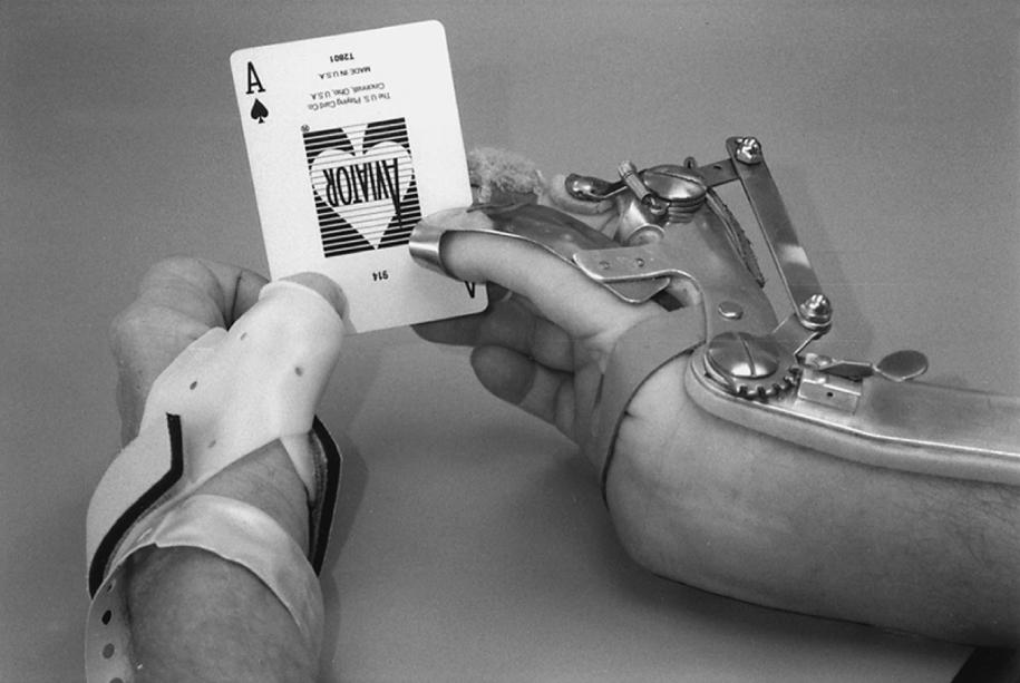 Fig. 55.4, This card-playing patient with a C6 spinal cord injury uses a molded thumb-opposition splint to pinch better with the right hand and a lightweight metal tenodesis orthotic that pinches the thumb to the next two fingers when he dorsiflexes his wrist.