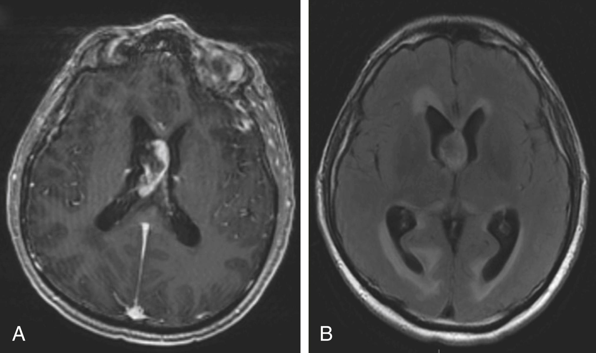 Fig. 19.1, MRI of the patient in Case 19.1 . (A) Axial fluid-attenuated inversion recover image showing dilation of the lateral ventricles with obstructive hydrocephalus and trans-ependymal flow of cerebrospinal fluid. (B) Axial post-contrast T1-weighted image reveals a contrast - enhancing mass of the septum pellucidum.