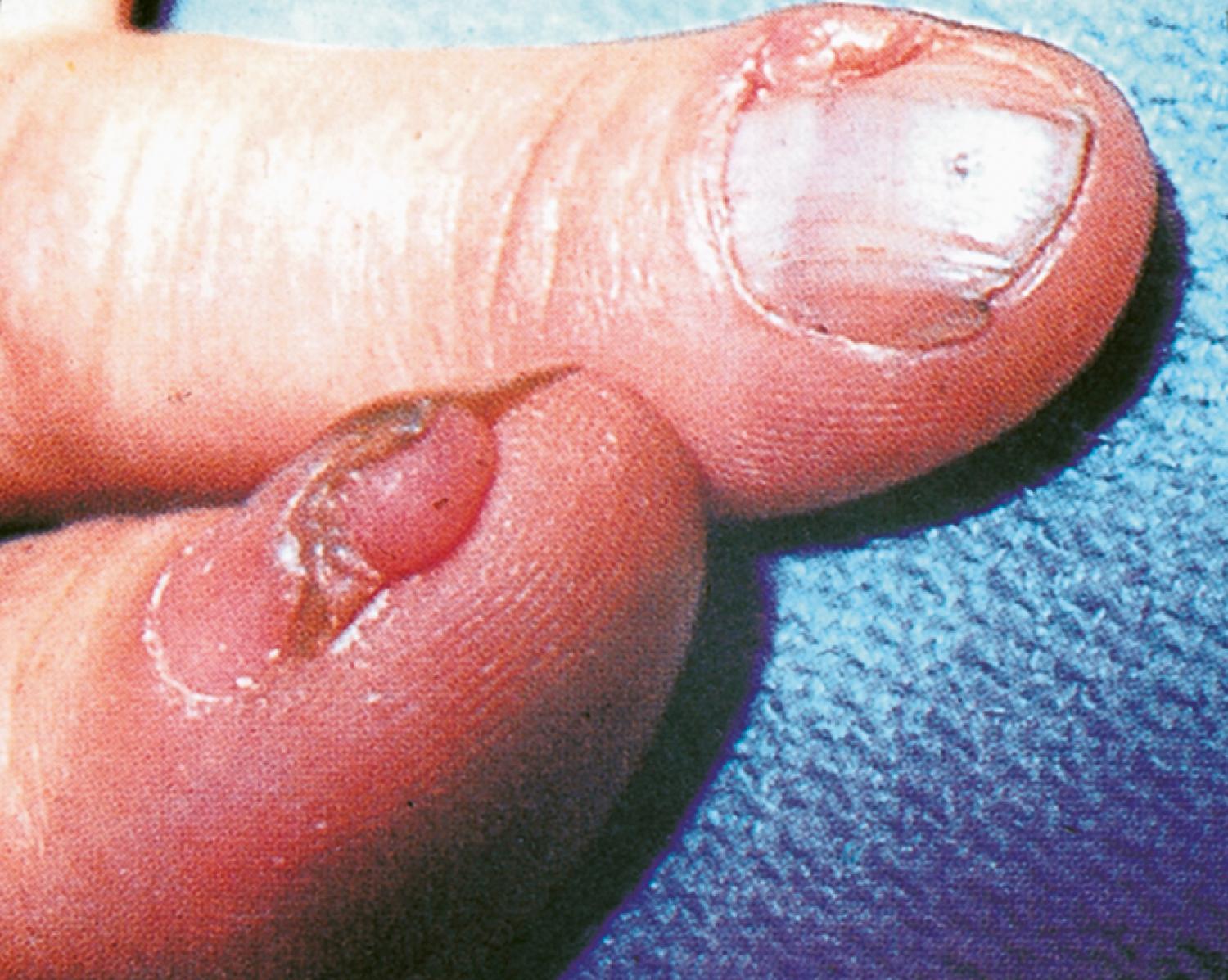 Fig. 16.11, Tuberous sclerosis (TS). Periungual fibromas. These nodular lesions can occur singly or multiply in the ungual or periungual areas.