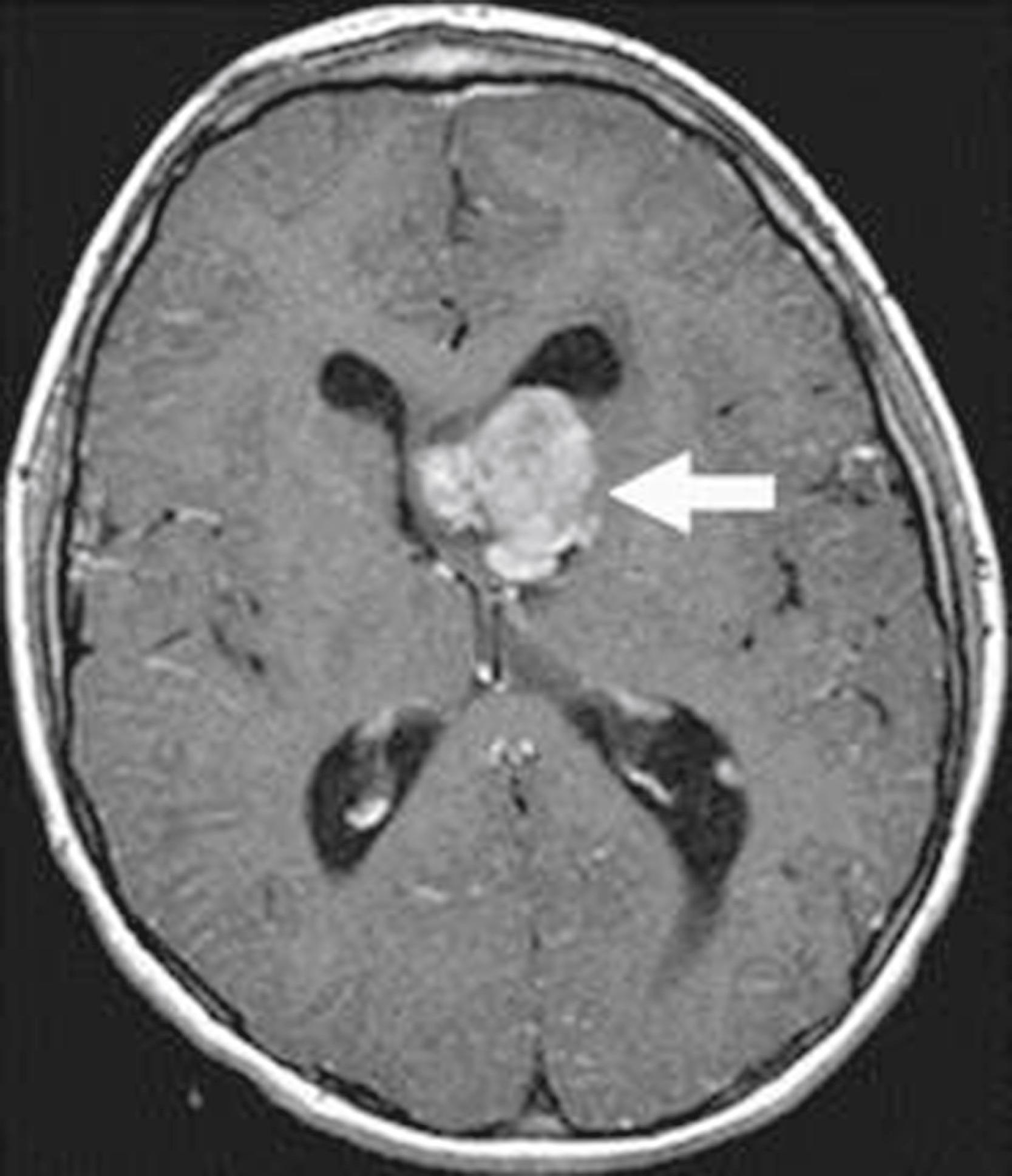 Fig. 16.14, Tuberous sclerosis (TS). Magnetic resonance imaging (MRI) demonstrates a large subependymal giant cell astrocytoma (SEGA) with ventricular dilation.