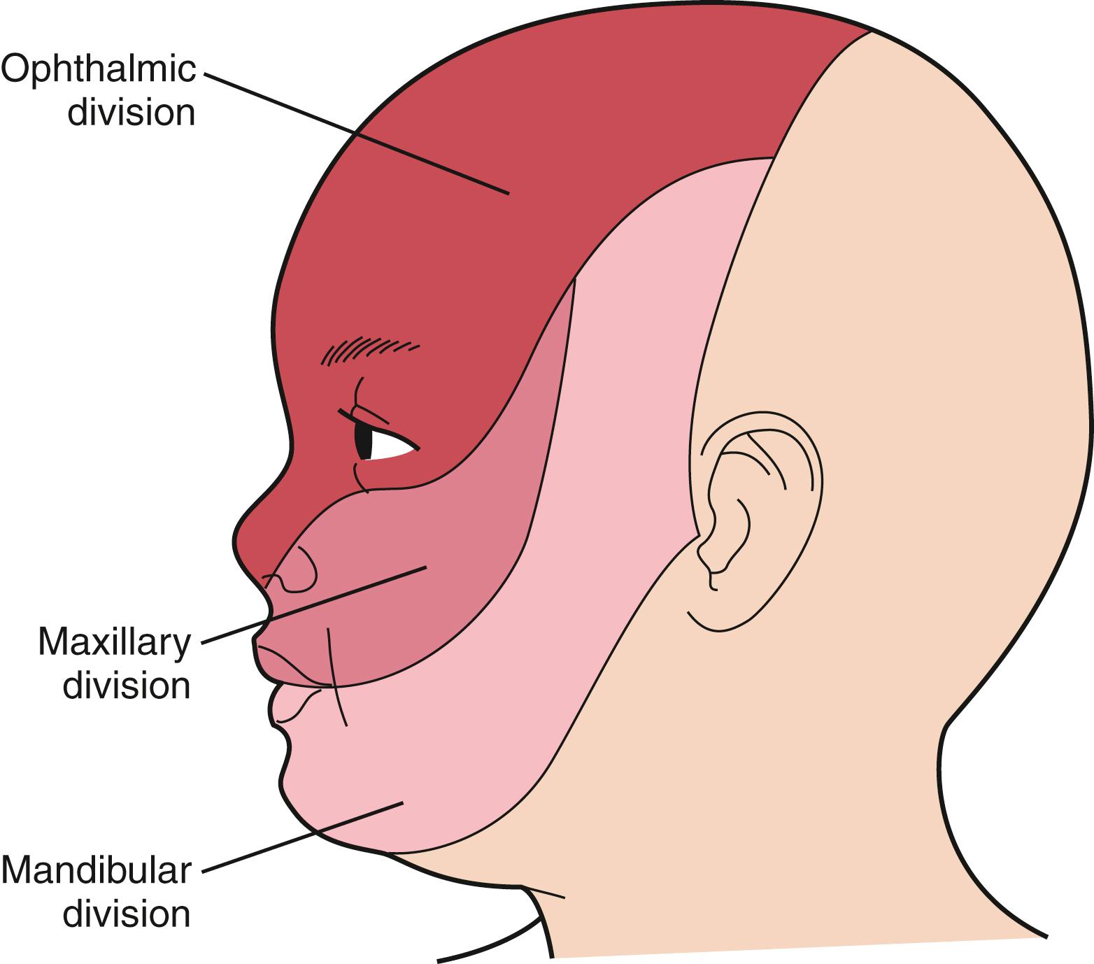 Fig. 16.16, Sturge-Weber syndrome. Cutaneous distribution of the division of the trigeminal nerve. Only patients with facial port-wine stains that involve the ophthalmic division are at risk for associated neuro-ocular symptoms.