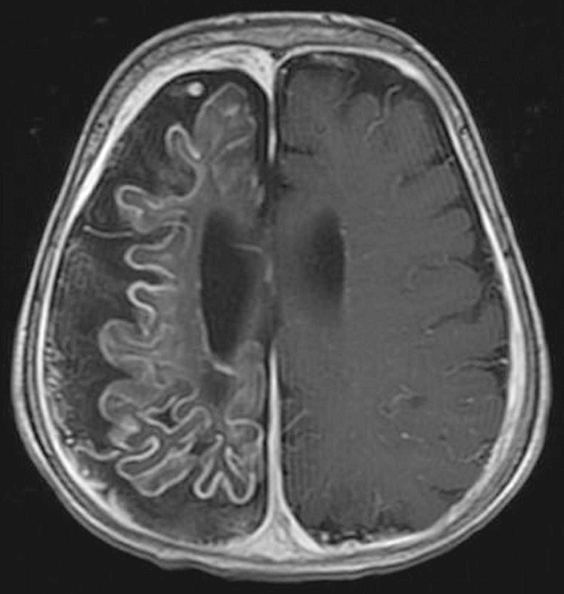 Fig. 16.17, Sturge-Weber syndrome. Magnetic resonance imaging (MRI) demonstrates gyriform contrast enhancement and hemispheric atrophy of the right hemisphere.