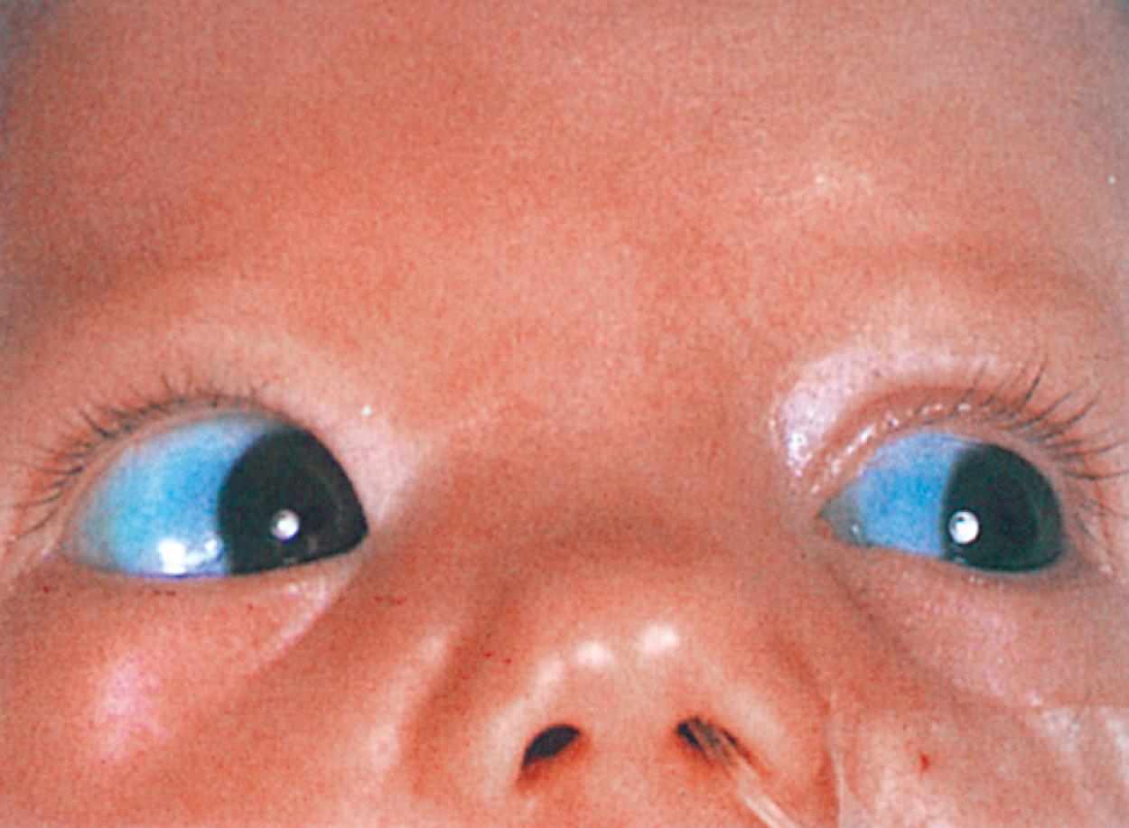 Fig. 16.18, Buphthalmos. Enlargement of the cornea of the right eye is evident. This is one of the associated ocular findings in Sturge-Weber syndrome and should prompt urgent evaluation for associated glaucoma.