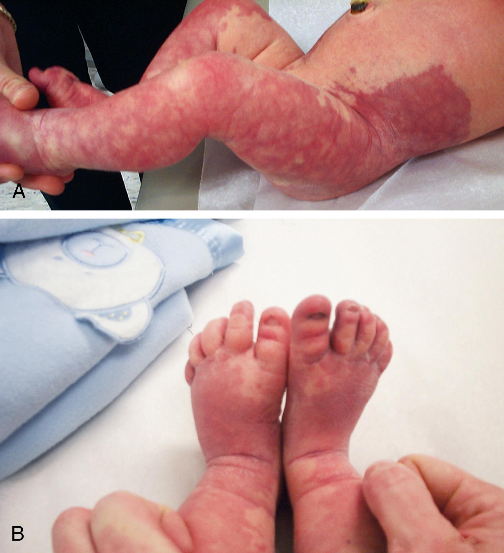 Fig. 16.19, Klippel-Trénaunay syndrome (KTS). (A) This infant with KTS is unusual in that he has vascular malformations involving both lower extremities, which extend upward over the lateral aspects of the abdominal wall. (B) In this view of his feet, one can appreciate a greater degree of hypertrophy on the right.