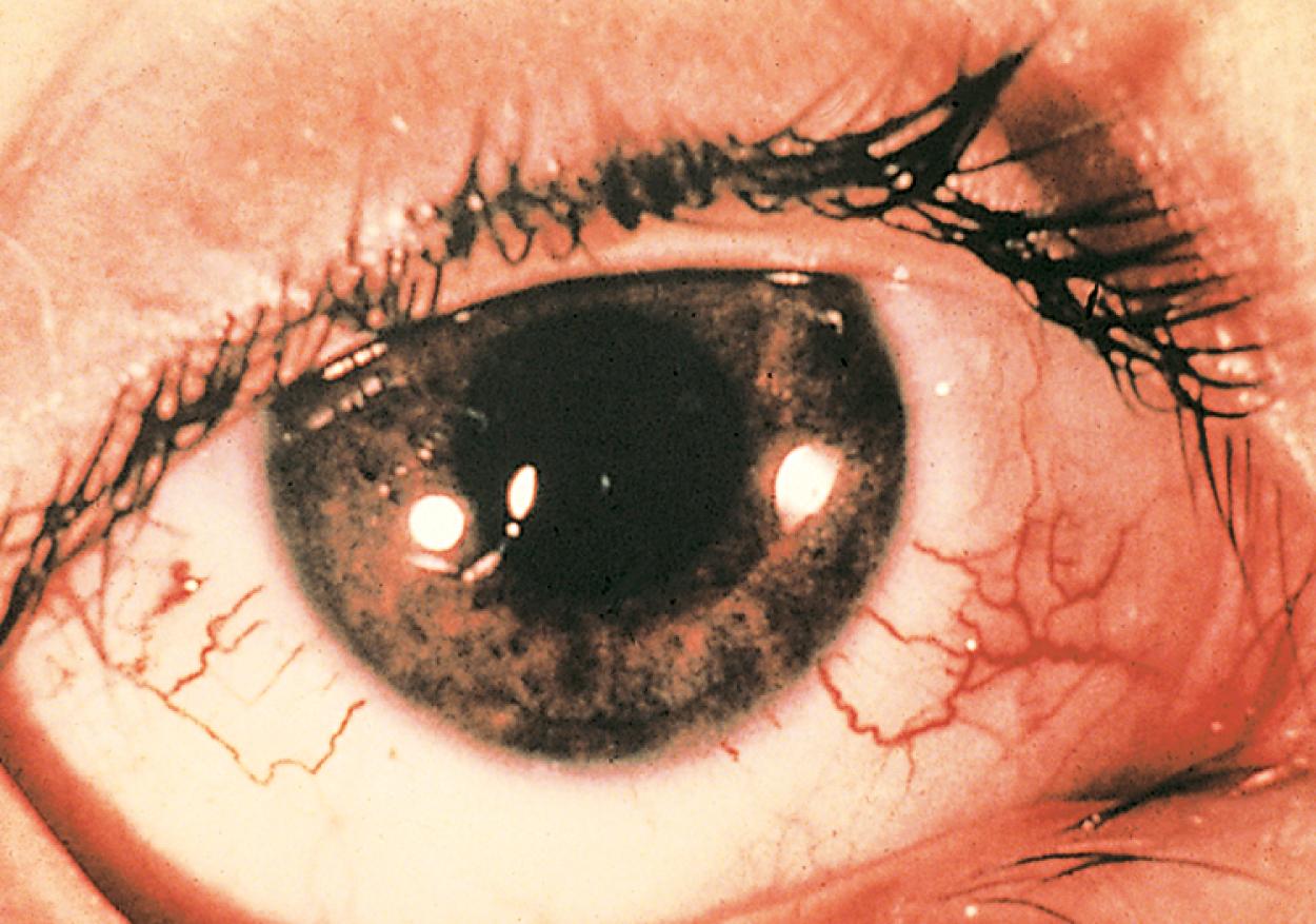 Fig. 16.20, Ataxia-telangiectasia. Characteristic telangiectases in the bulbar conjunctiva usually develop between 3 months and 6 years old.