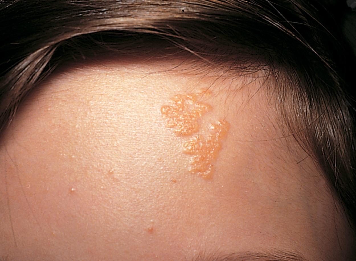 Fig. 16.21, Linear nevus sebaceus of Jadassohn. This yellowish-tan, waxy-appearing lesion became elevated at puberty and was associated with seizures and intellectual disability.