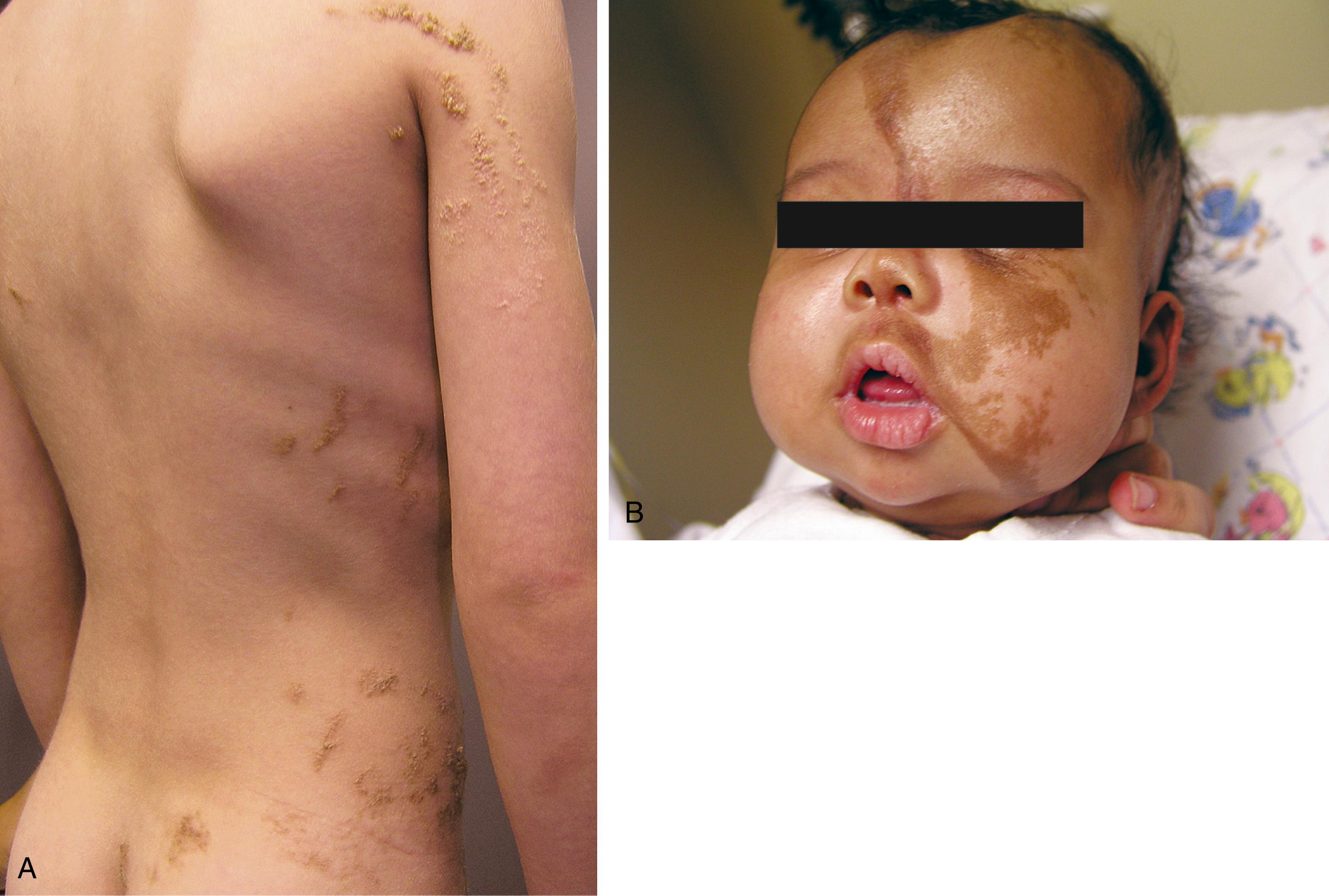 Fig. 16.22, Epidermal nevus syndrome. (A) Hyperpigmented verrucous papules are seen unilaterally over the upper arm, trunk, hip, and lumbosacral area of this adolescent boy. He had had a seizure in infancy and was learning disabled. (B) In this infant, raised hyperpigmented lesions are present on the left face and both sides of the forehead and were associated with intractable seizures.