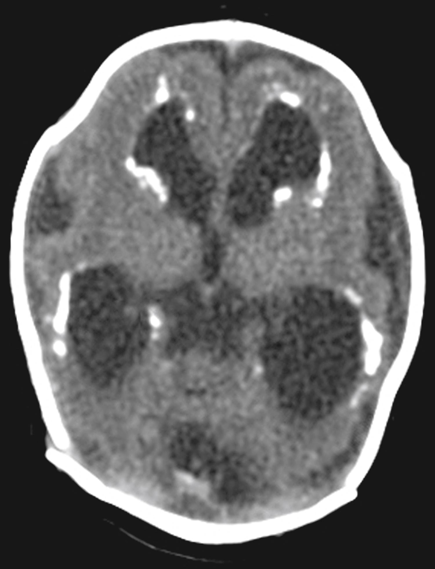 Fig. 16.23, Computed tomography (CT) scan revealing bilateral periventricular cerebral calcifications with ventricular dilation in infant with severe congenital cytomegalovirus infection.