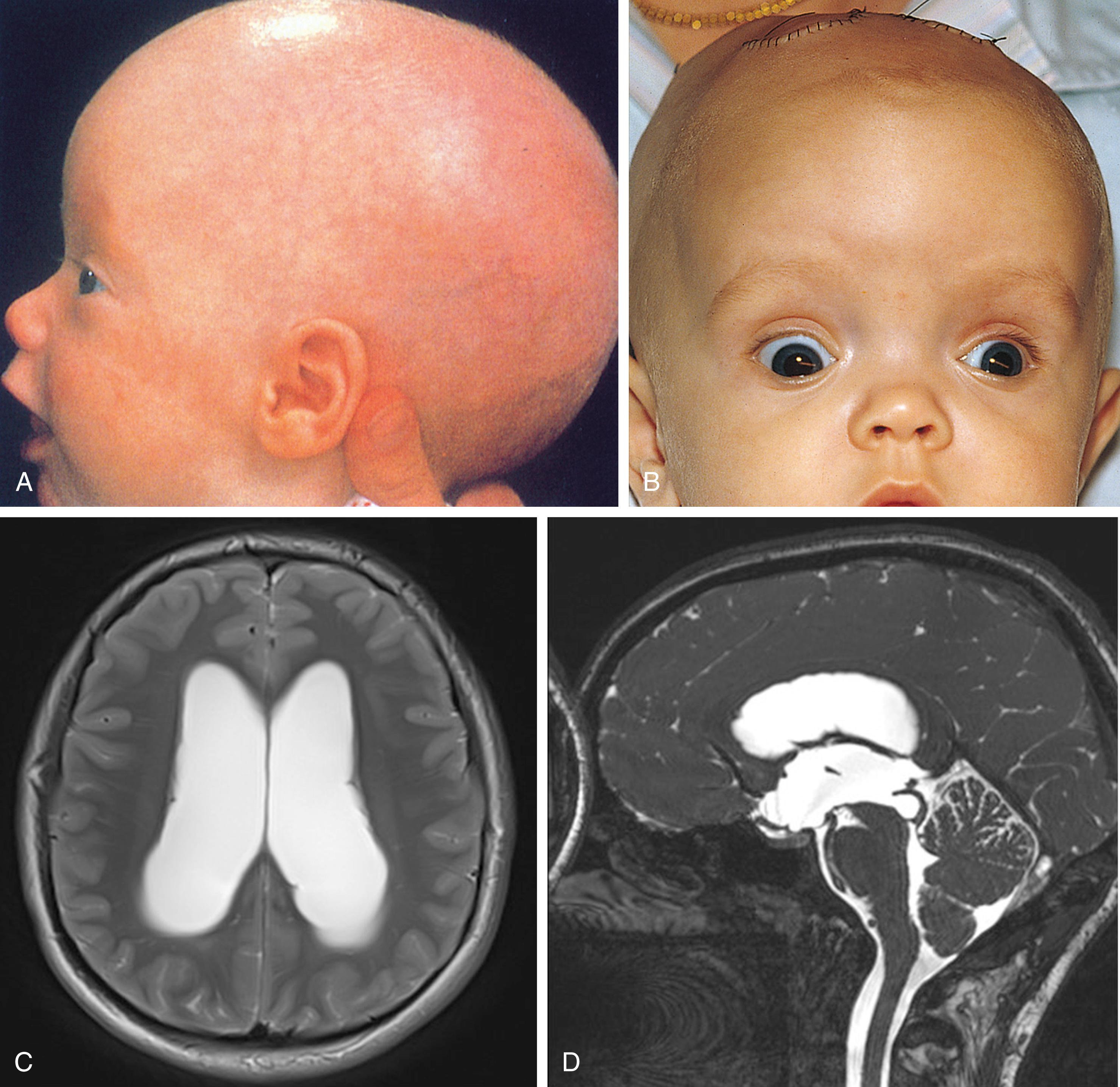 Fig. 16.24, Infantile hydrocephalus. (A) Characteristic enlarged head, thinning of the scalp, distended scalp veins, and a full fontanelle. (B) Paresis of the upward gaze is seen in an infant with hydrocephalus resulting from aqueductal stenosis. Paresis is more apparent on the right. This phenomenon is often termed the sunsetting sign. (C) T2-weighted MRI showing ventriculomegaly and transependymal edema. (D) The cerebral aqueduct is enlarged with an apparent web within the inferior aqueduct.