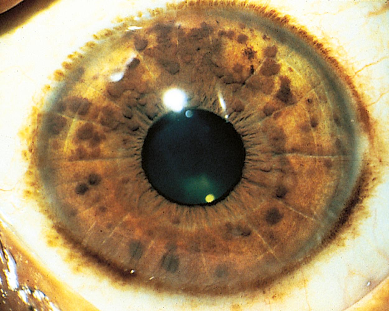 Fig. 16.5, Neurofibromatosis 1 (NF-1). Pigmented hamartomas of the iris (Lisch nodules).