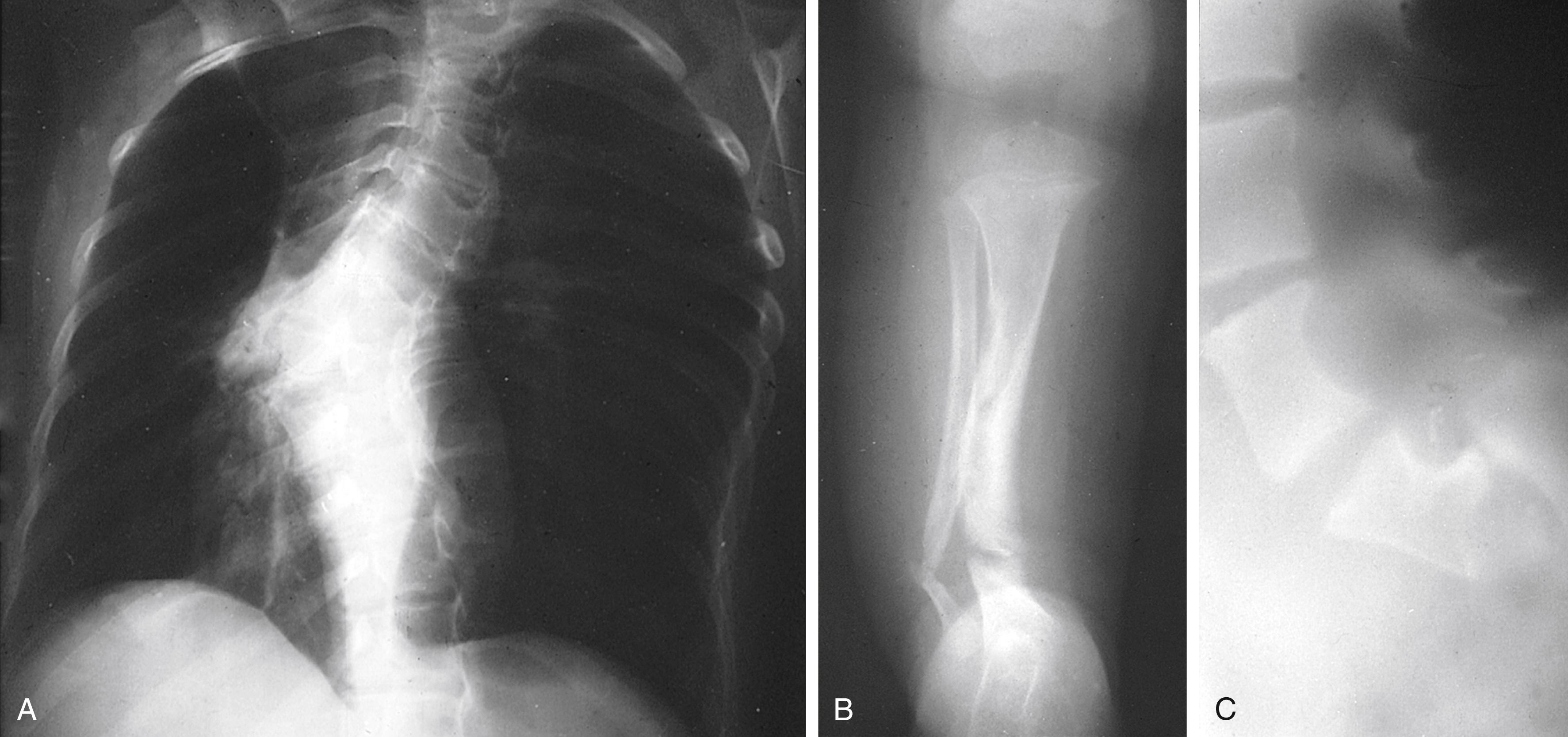 Fig. 16.6, Neurofibromatosis 1 (NF-1). Radiographic manifestations of skeletal abnormalities. (A) Severe angular scoliosis and vertebral dysplasia. (B) Congenital bowing and pseudarthrosis of the tibia and fibula. (C) Scalloping of the posterior margins of the vertebral bodies resulting from dural ectasia.