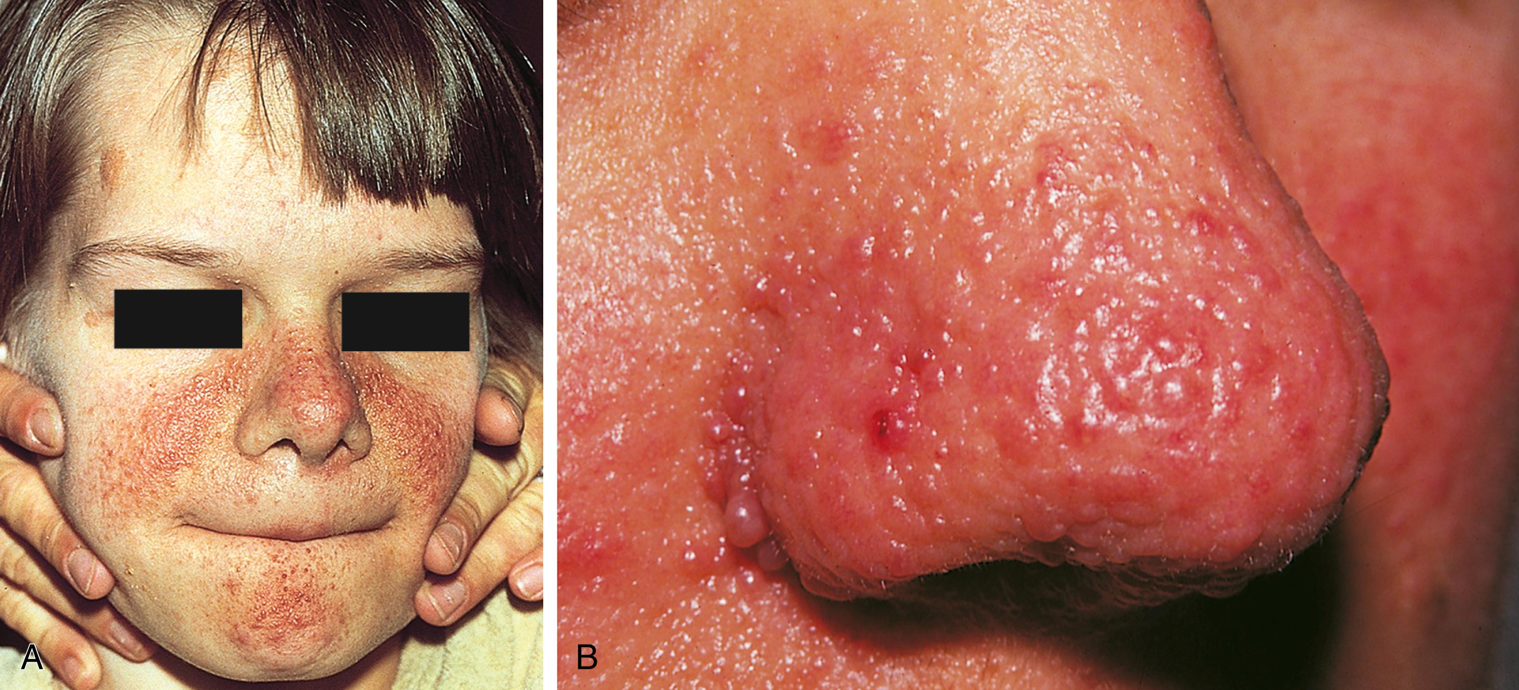 Fig. 16.8, Tuberous sclerosis (TS). (A) This adolescent boy had adenoma sebaceum in a characteristic malar distribution and chin lesions as well. (B) A close-up view of nasal lesions is shown.