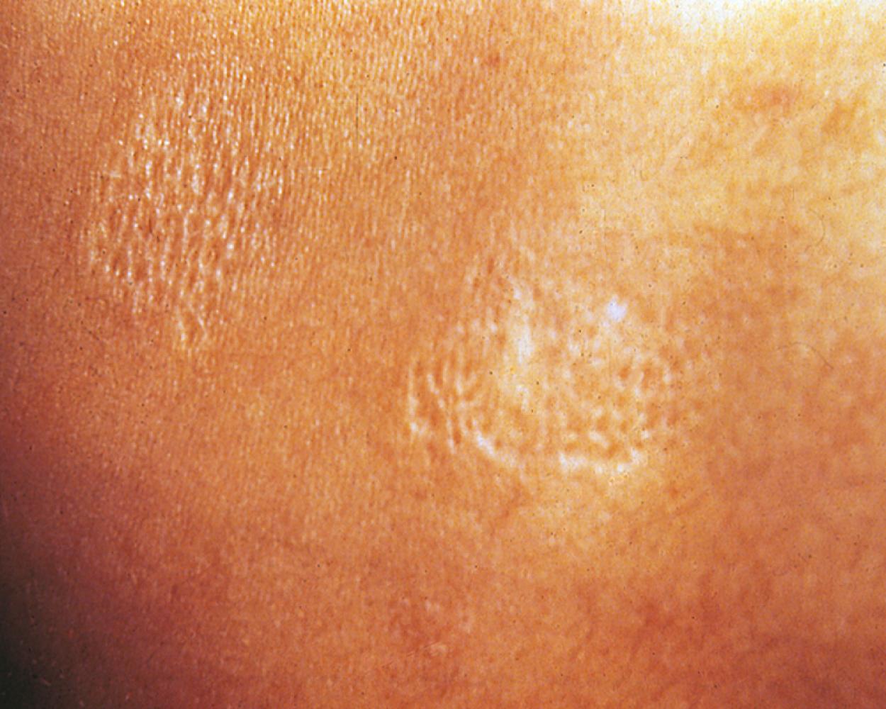 Fig. 16.10, Tuberous sclerosis (TS). Shagreen patch. This plaque of thickened skin with a cobblestone texture is distinctive but is one of the less common cutaneous manifestations.