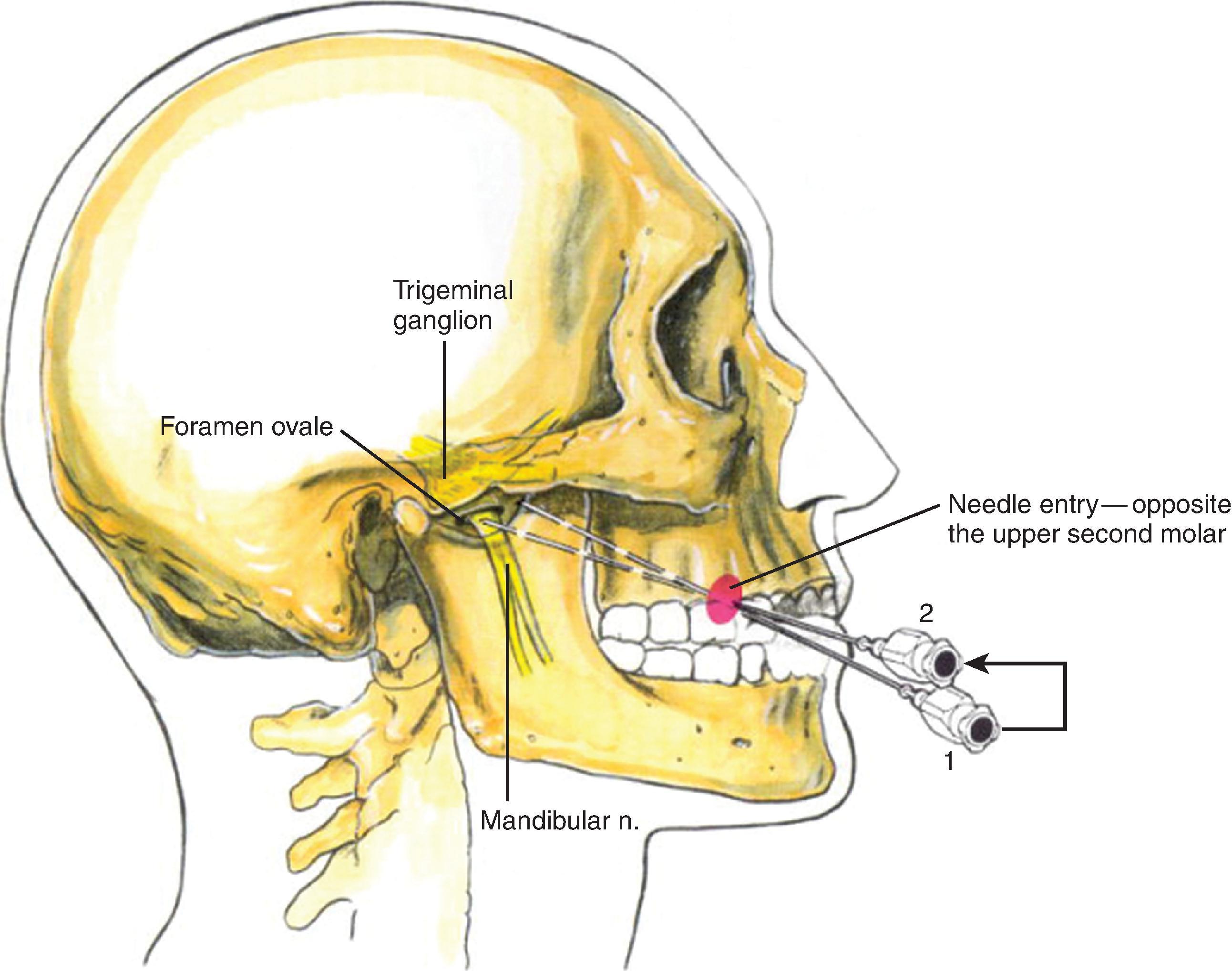 Figure 63.1, Trigeminal ganglion block: anatomy and technique. (Reprinted with permission from Brown D. Atlas of Regional Anesthesia . 3rd ed. Philadelphia: Saunders, an imprint of Elsevier; 2006: Figure 20-5.)