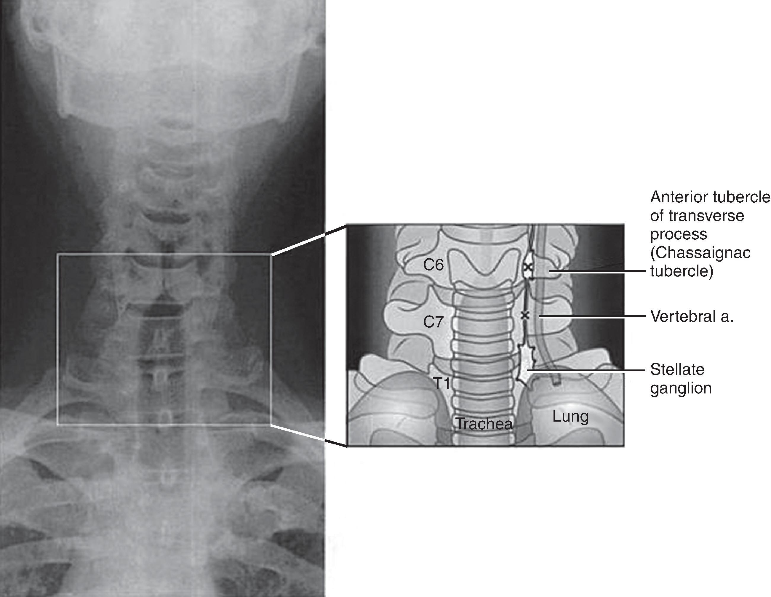 Figure 63.3, Stellate ganglion anatomy. The relative position of the stellate ganglion, the vertebral artery, and the inferior cervical vertebrae. The relative positions of the C6, C7, T1 vertebral bodies of the Chassaignac tubercle (anterior tubercle of C6 transverse process) and the vertebral artery are illustrated. The vertebral artery traverses within the bony foramen at the C6 level, but the presence of a bony foramen at C7 is variable, and here the artery often courses unprotected anterior to the C7 transverse process. (Adapted from Janik IE, Hoeft MA, Rathmell J. Anatomic variation of Chassaignac tubercle measured by computed tomography: implications for stellate ganglion block. Presented at the annual fall meeting of the American Society of Regional Anesthesia and Pain Medicine; November 7-10, 2002, Phoenix, AZ; and Rathmell JP. Atlas of image-guided intervention in regional anesthesia and pain, 2005, Figure 10-2.) Rathmell JP; Atlas of Image Guided Intervention in Regional Anesthesia and Pain Medicine, Lippincott Williams and Wilkins: Philadelphia, 2005; Figure 10-2.