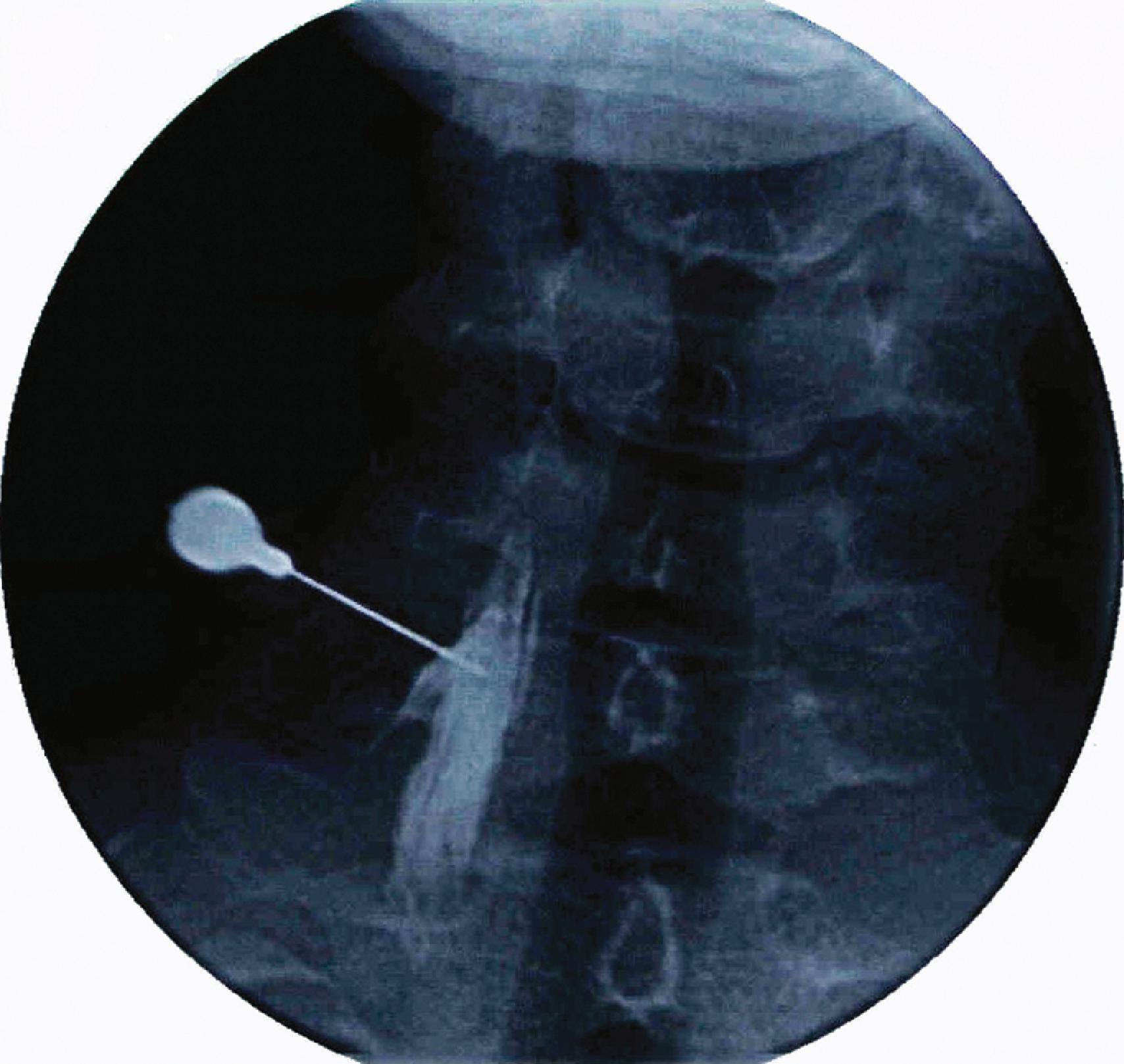 Figure 63.4, Anteroposterior fluoroscopy shows a block needle placed at the anterior base of the C6 transverse process. Injected contrast material is seen within the longus colli muscle.