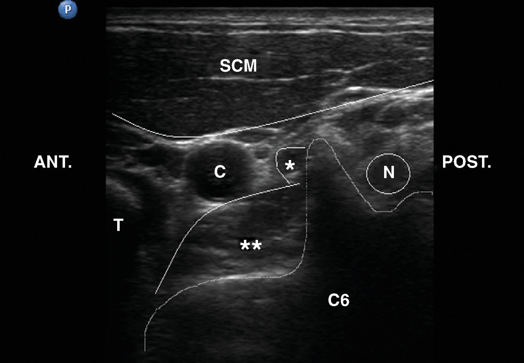 Figure 63.5, Short-axis view at the C6 level. Asterisk , Longus capitis muscle; two asterisks , longus colli muscle; C , carotid artery; C6 , sixth cervical vertebra with a prominent anterior tubercle. N , C6 nerve root; SCM , sternocleidomastoid muscle; T , trachea.