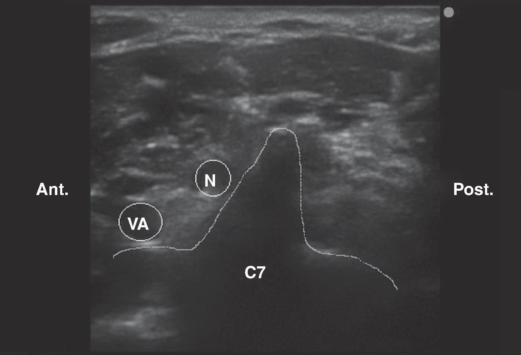 Figure 63.6, Short-axis view at the C7 level. C7 , Seventh cervical vertebra with only one tubercle; N , C7 nerve root; VA , vertebral artery.