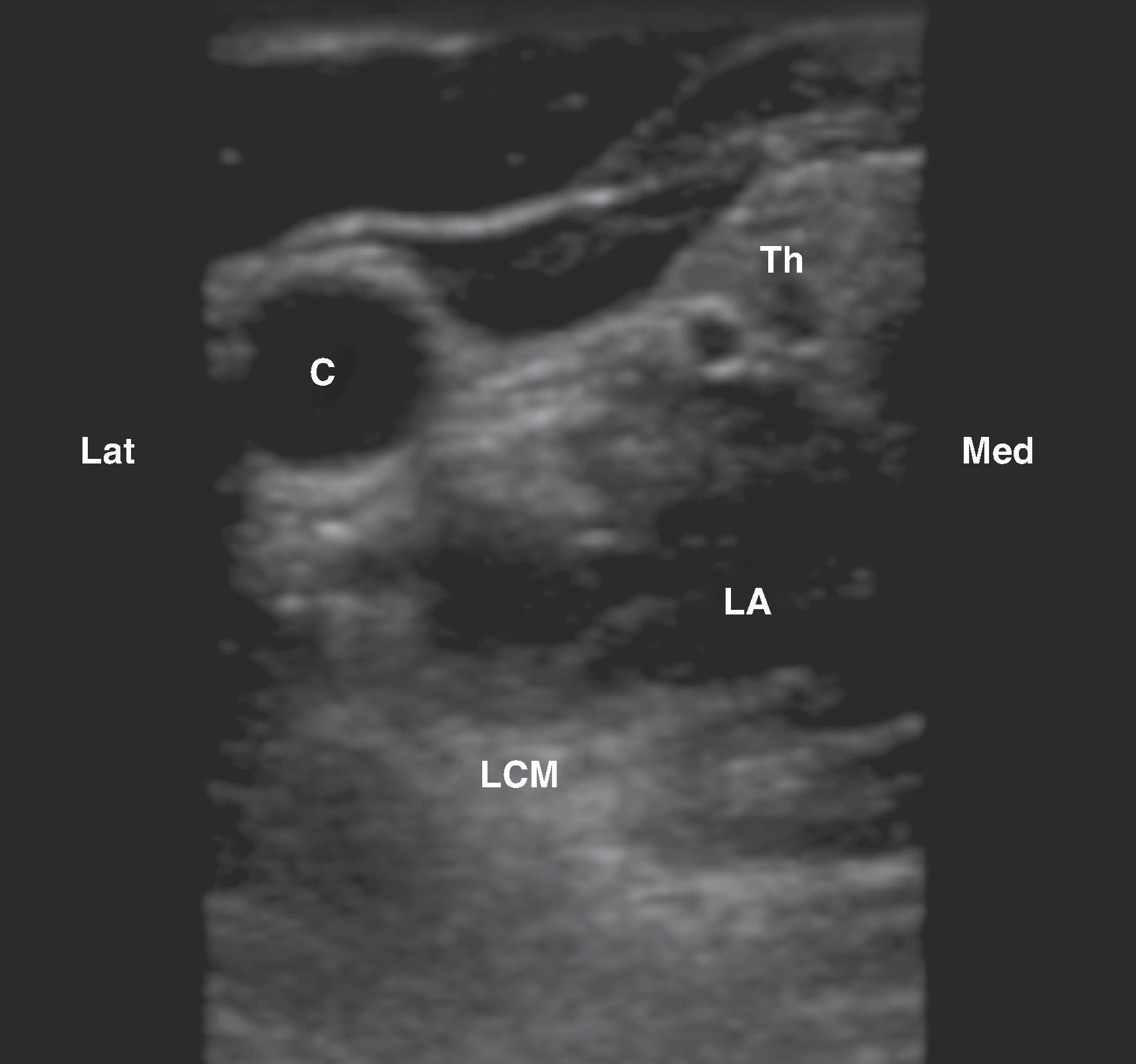 Figure 63.7, Injection of local anesthetic produced an anechoic signal. After injection, the longus colli muscle (LCM) appears hyperechoic. C , Carotid artery; Th , thyroid.