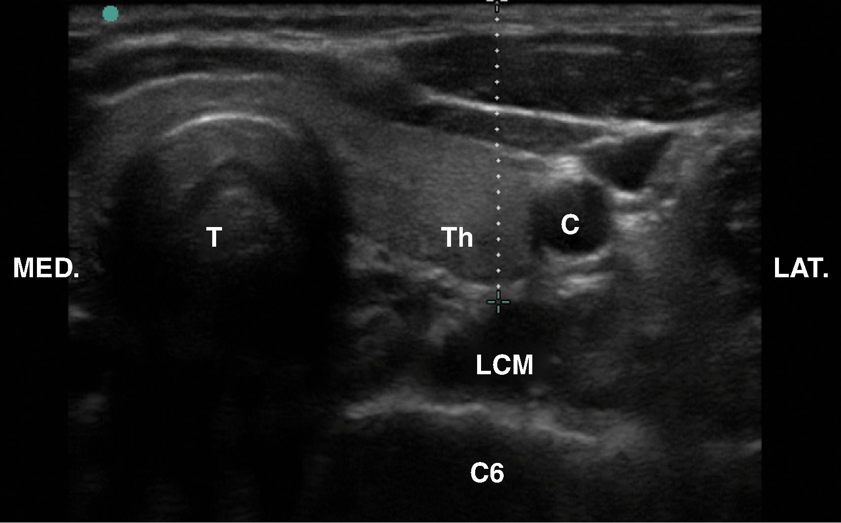 Figure 63.8, Anterior ultrasound-guided approach. The dotted line represents the needle trajectory; it is trespassing through the thyroid (Th) . C , Carotid artery; C6 , sixth cervical vertebra; LCM , longus colli muscle; T , trachea.