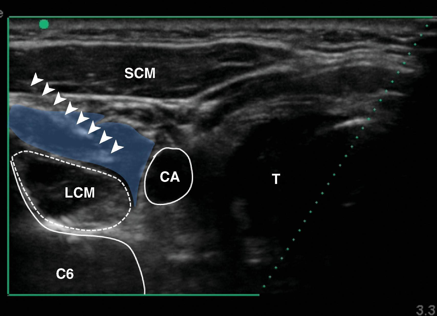 Figure 63.9, Lateral ultrasound-guided approach. The needle (arrowheads) is placed under the prevertebral fascia. Local anesthetic (semitransparent figure) spread superficially to the longus colli muscle (LCM) and posteriorly to the carotid artery. C6, sixth cervical vertebra; SCM, sternocleidomastoid muscle; T, trachea.