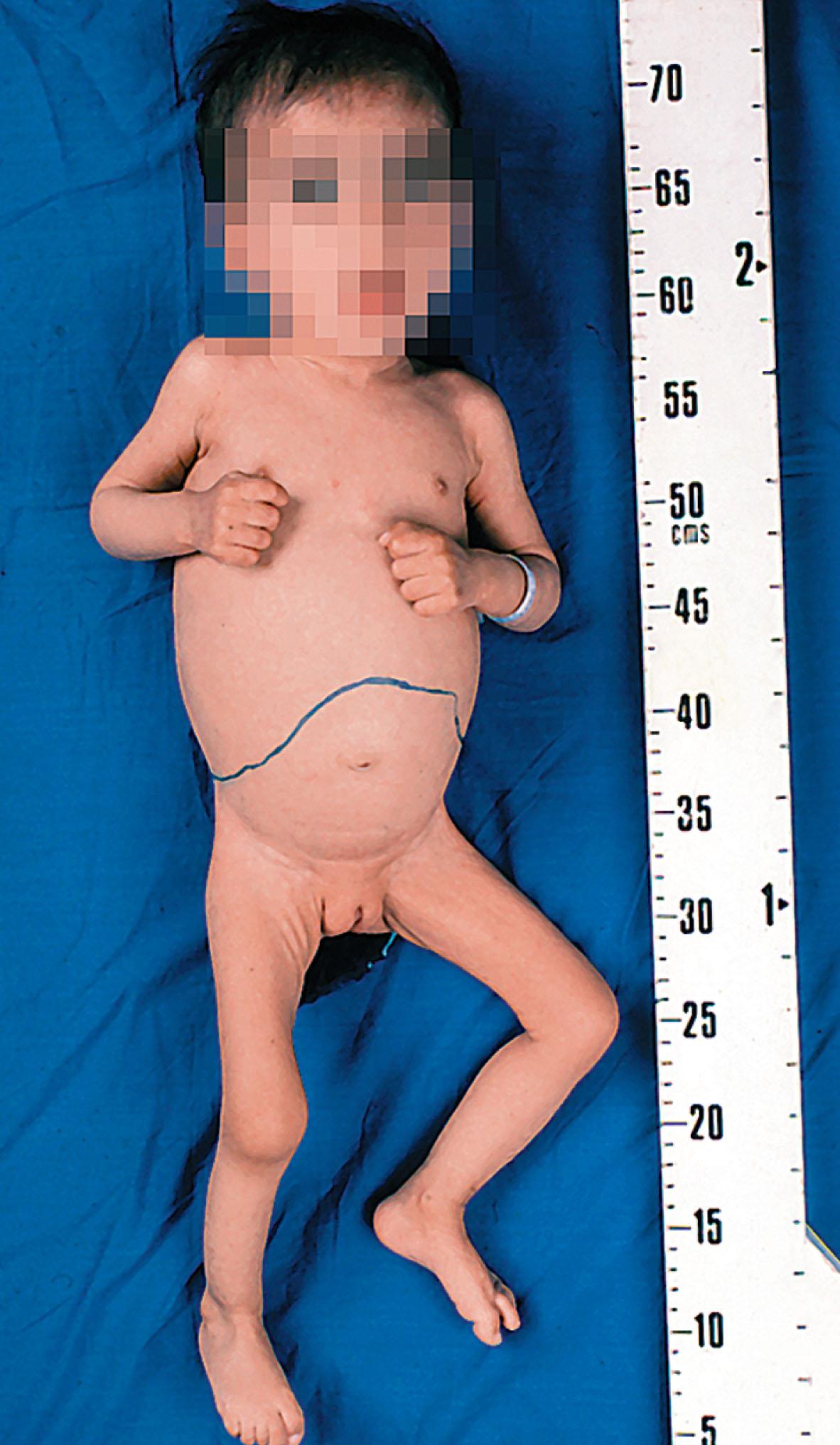 Fig. 65.12, An infant with Niemann–Pick type A showing the hepatomegaly and spastic posture.