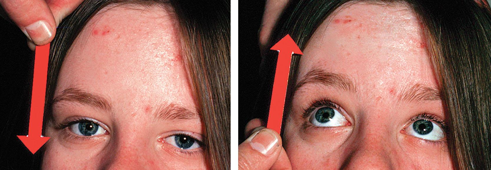 Fig. 65.13, Downgaze palsy in a child with Niemann–Pick type C. The arrow denotes the direction that the child is being told to look. Horizontal and upgaze were normal.