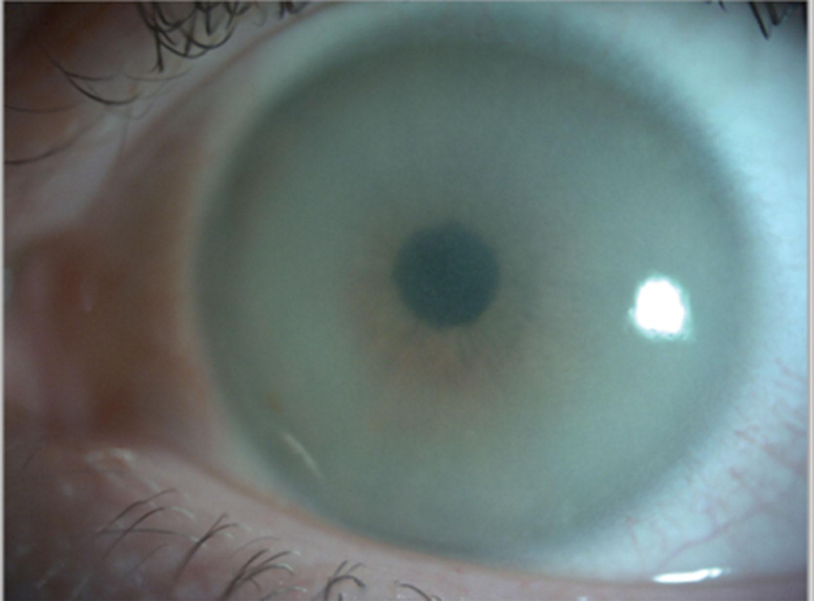 Fig. 65.2, Corneal clouding in a patient with MPS VI Maroteaux–Lamy.