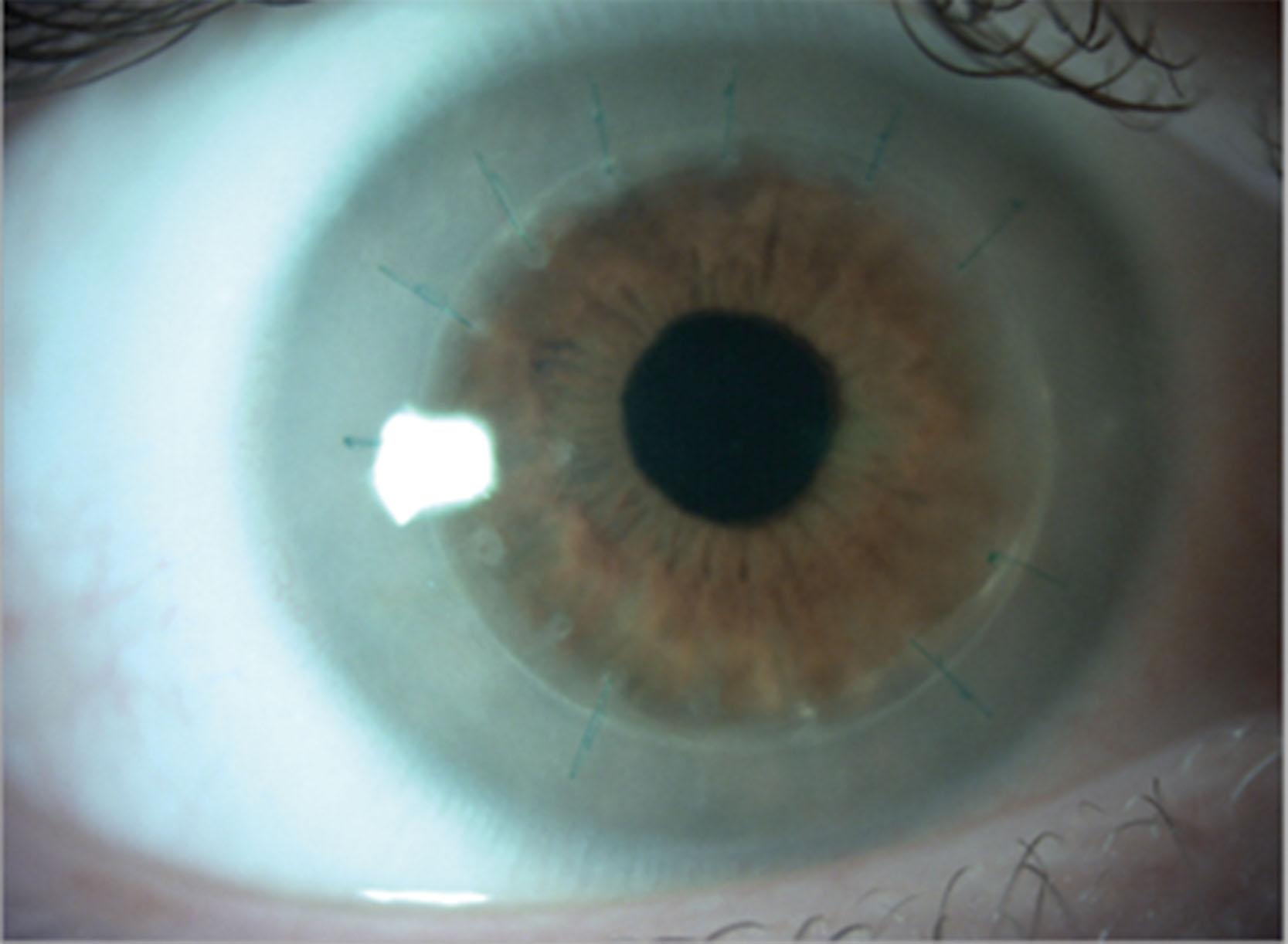 Fig. 65.4, A penetrating keratoplasty in a patient with MPS VI Maroteaux–Lamy.