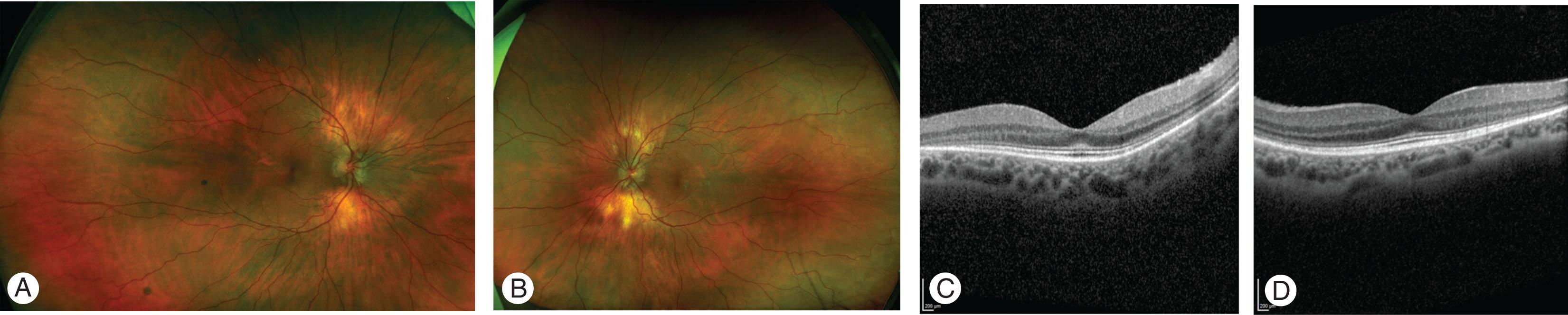 Fig. 65.5, (A–B) Optos wide-field digital imaging showing retinal pigment epithelial changes and full optic discs in a 24-year-old patient with MPS II Hunter. Vision was 0.1 LogMar right and 0.2 left. ERG was attenuated in dark-adapted conditions. (C–D) OCT of the same patient showing thickening of the external limiting membrane.
