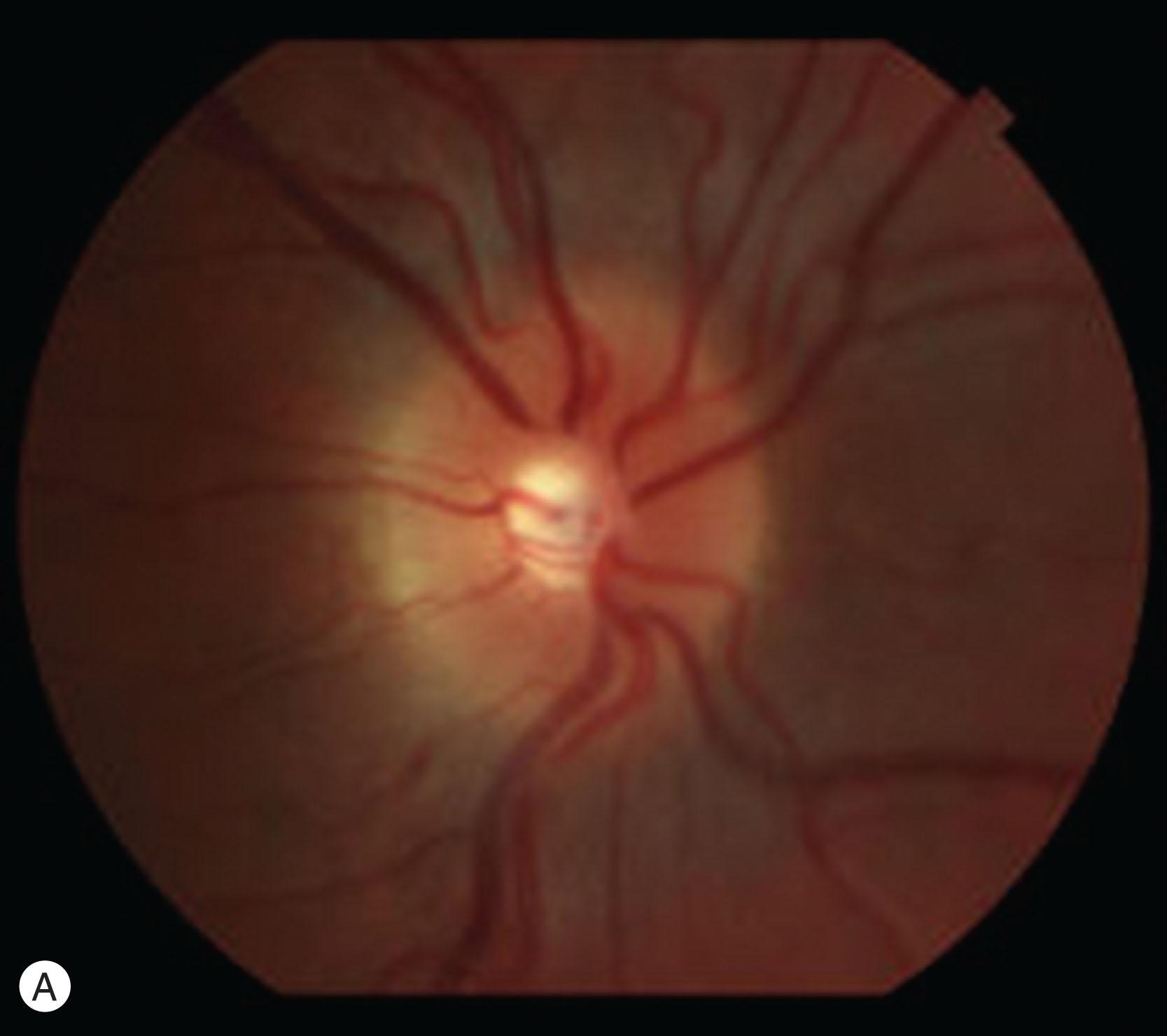 Fig. 65.6, (A–B) “Full” optic discs in a 14-year-old patient with MPS II. (C–D) Ultrasound of the same optic nerves as in (A) and (B), showing thickening of sclera and increase in diameter of the optic nerve.