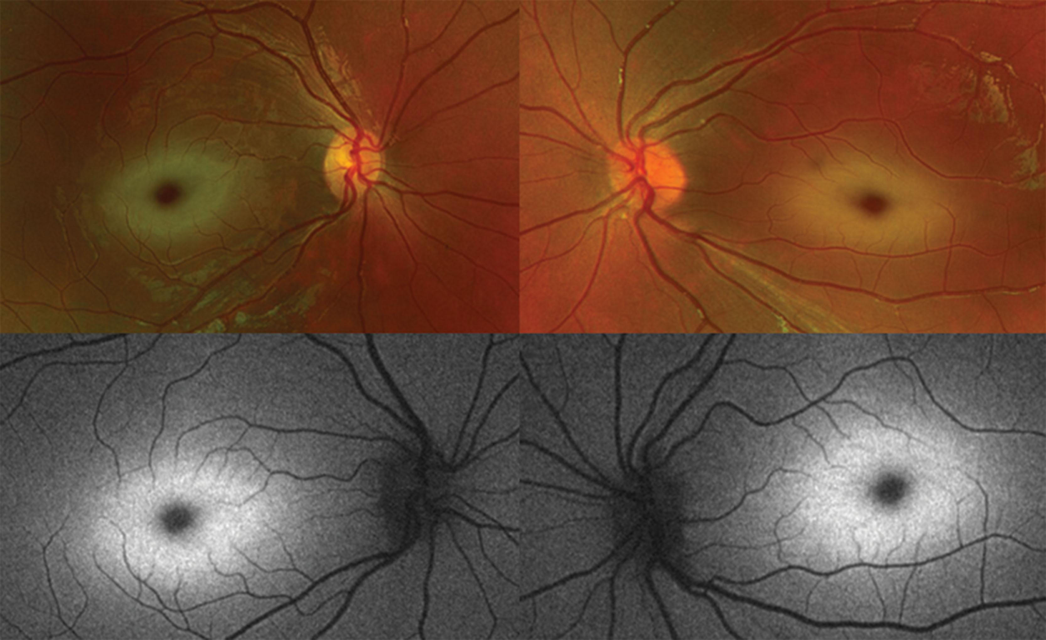 Fig. 65.8, A 4-year-old boy was noted at a routine optometry appointment to have pale retinas. Vision was 0.325 right and 0.450 left with glasses. Digital fundal image and autoflorescence demonstrated cherry-red spots. Metabolic testing showed that he had a significant quantity of bound sialic acid in his urinary oligosaccharide sample, indicating a diagnosis of cherry-red spot myoclonus syndrome (neuraminidase deficiency, sialidosis).