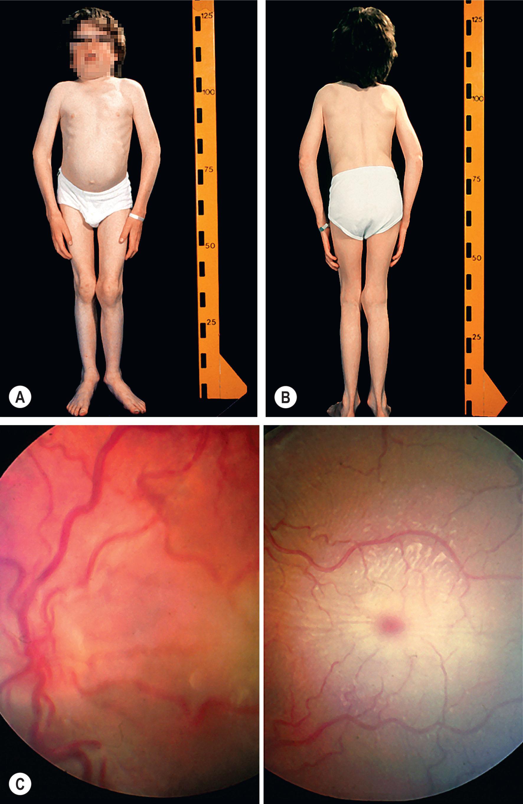 Fig. 65.9, (A–B) Patient with sialidosis type 2. He has kyphoscoliosis and joint changes. (C) Same patient as in (A) and (B), showing a cherry-red spot. The picture is hazy because of corneal clouding.