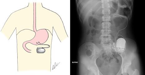 Figure 119.1, On the left is a diagram showing the implanted pulse generator and attached electrodes used in permanent gastric electrical stimulation (GES). On the right is an abdominal radiograph of an adolescent treated with permanent GES.