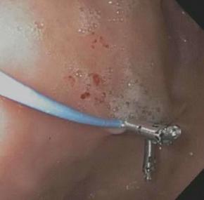 Figure 119.2, This endoscopic image shows the placement of an electrode into the gastric mucosa for use during a period of temporary gastric electrical stimulation. The electrode has been secured using two endoscopic clips.