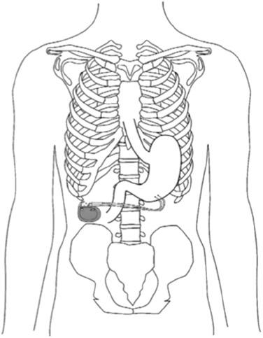 Figure 118.2, Gastric electrical stimulation (GES) system and its location. The GES unit comprised a pair of leads secured in the muscularis propria along the greater curvature, 10 cm proximal to the pylorus, 1 cm apart, and connected to an implantable battery-powered neurostimulator positioned subcutaneously in the abdominal wall.