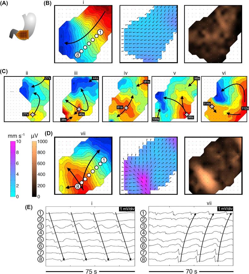 Figure 118.3, Abnormal slow-wave initiation: unstable focal events and stable ectopic pacemaking; examples from diabetic gastroparesis (ID#5). Isochronal intervals = 1 s. (A) Position diagram. (B) Normal activity was initially mapped for 280 s (freq. 3.3 ± 0.1 SD c/min). Isochrone, velocity, and amplitude maps are shown for example wave ( i ). (C) An irregular tachygastria followed, due to unstable ectopic events arising at multiple locations (stars; duration ∼200 s). Isochronal maps of five representative cycles ( ii – vi ) demonstrate chaotic tissue activation and wave collisions, resulting in a range or frequencies across the mapped field (median 3.7 c/min; range: 1.4–5.7). Time stamps are referenced to the accompanying animation. (D) Regular tachygastria followed, due to stable ectopic activity (freq. 4.0 ± 0.05 SD c/min), with organized retrograde propagation occurring until the end of the recording period. Isochrone, velocity, and amplitude maps are shown for example wave ( vii ). During aberrant initiation, circumferential slow-wave propagation emerged, and was faster than normal longitudinal conduction (6.4 ± 2.0 SD vs. 2.8 ± 0.7 SD mm/s; P < .001), with higher amplitudes (595 ± 225 SD vs. 240 ± 150 SD μV; P < .001). (E) Representative electrograms from waves ( i ) and ( vii ), from the channels shown in B, D.