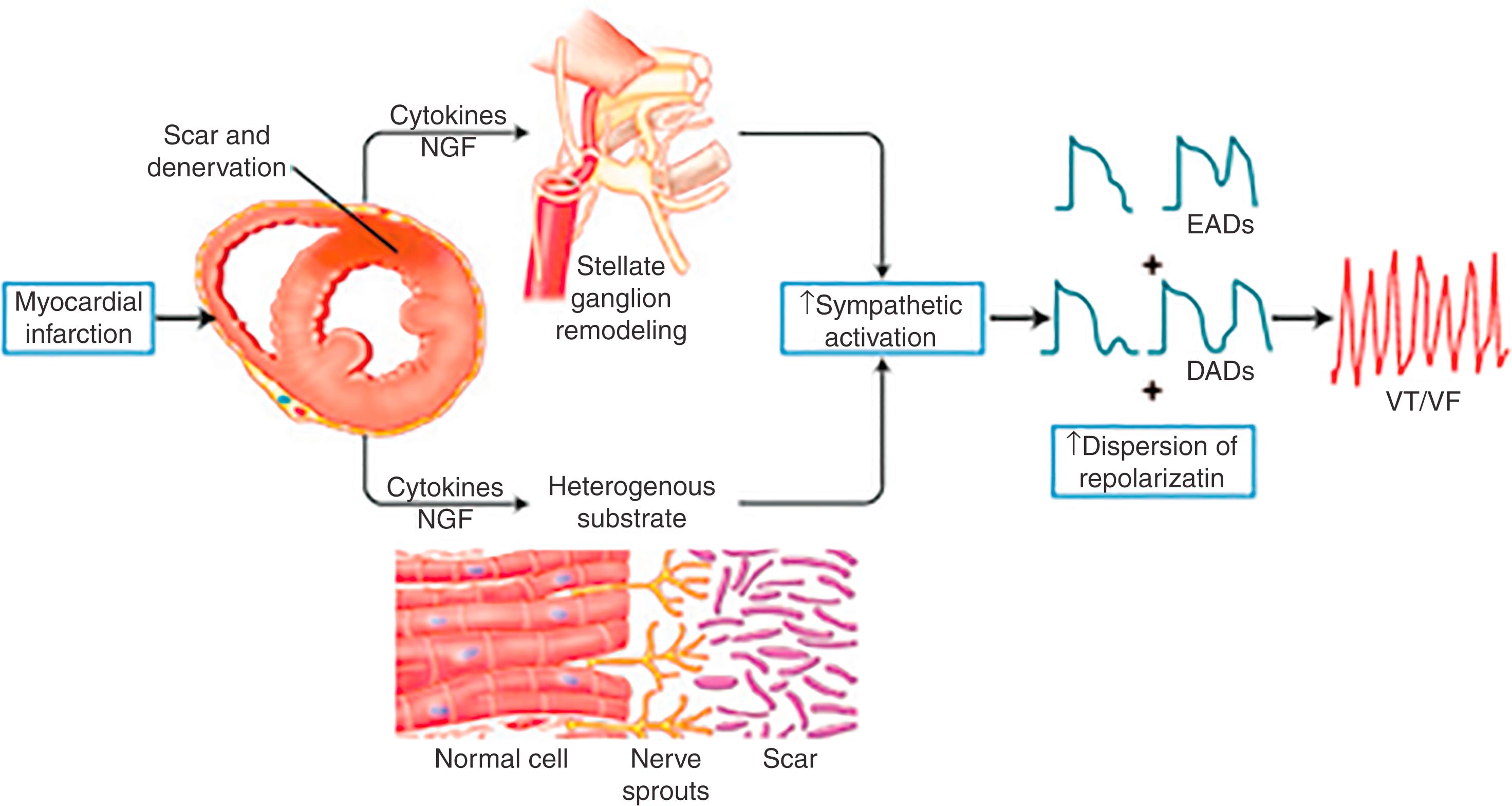 Fig. 137.2, Sympathetic neural remodeling after cardiac injury.