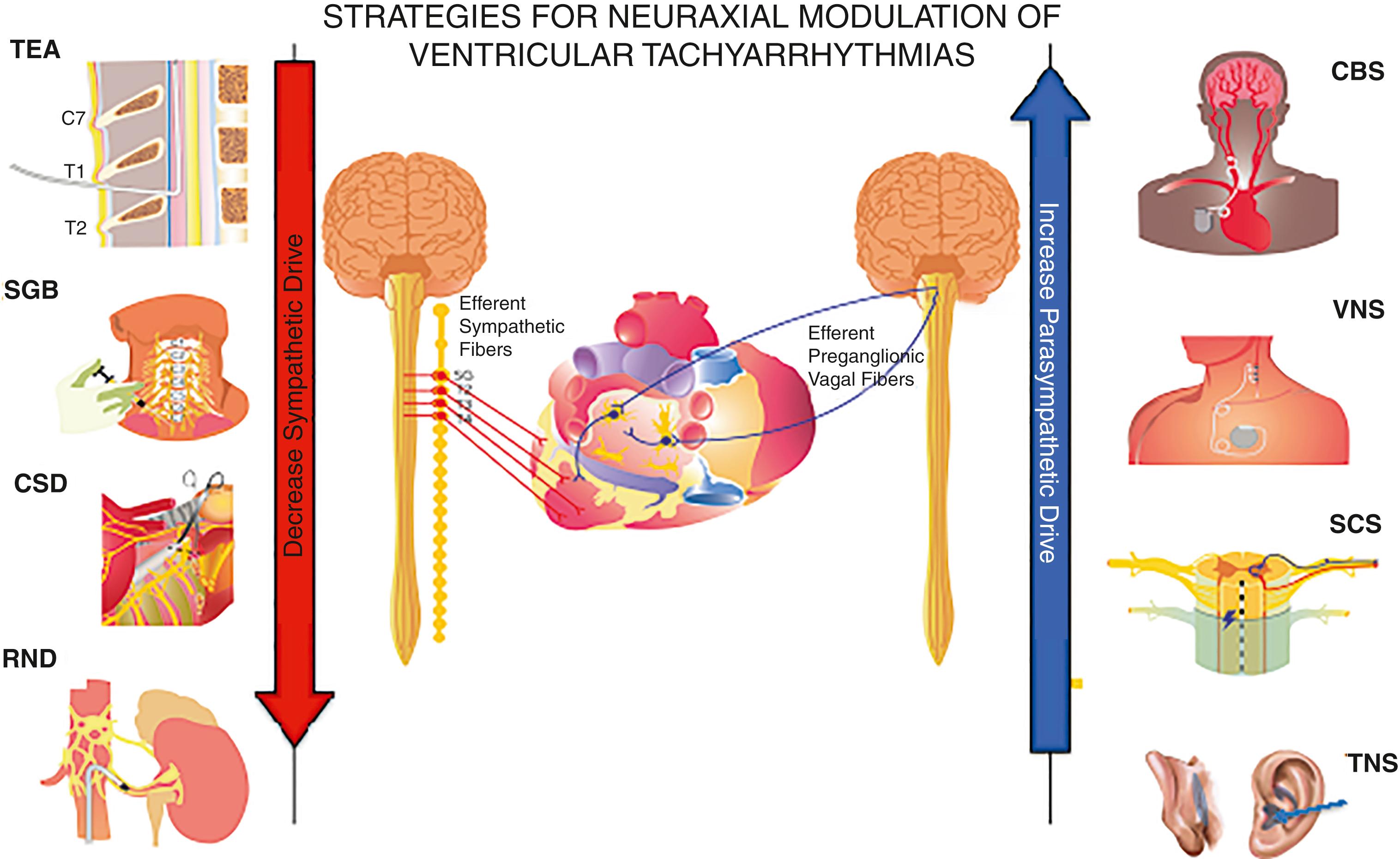 Fig. 137.3, Nonpharmacologic methods of neuraxial modulation of ventricular arrhythmias have relied on inhibiting the sympathetic nervous system and normalizing the decreased vagal outflow that accompanies structural heart disease and heart failure. CBS , Carotid baroreceptor stimulation; CSD, cardiac sympathetic denervation; RDN , renal denervation; SCS , spinal cord stimulation; SGB , stellate ganglion block; TEA , thoracic epidural anesthesia; TNS , tragus or transcutaneous vagal nerve stimulation; VNS , vagal nerve stimulation.
