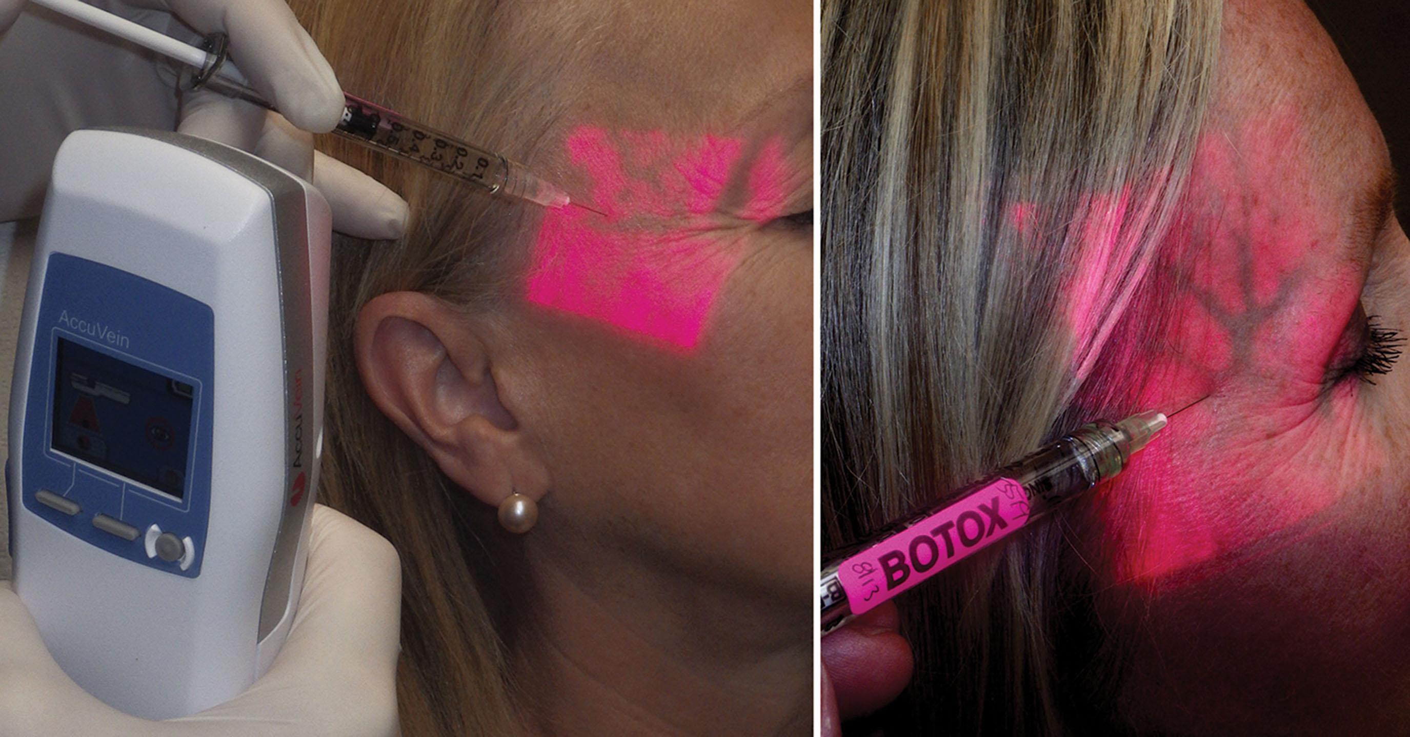 Fig. 9.14, The Accuvein device in use during neuromodulator injection is shown (left) . A close-up of the actual vein mapping seen over the patient’s skin is shown (right) .