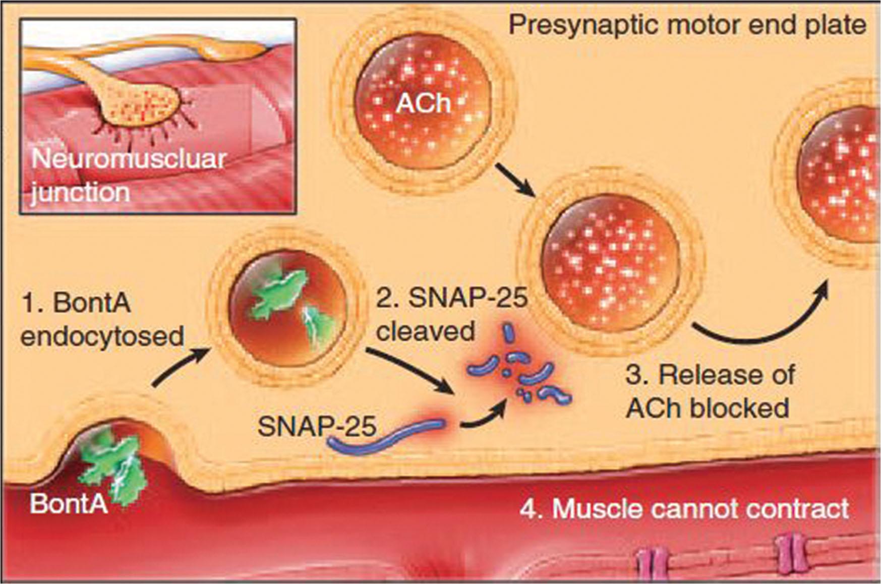 Fig. 9.7, This diagram chronicles the steps by which onabotulinumtoxin A prevents the release of acetylcholine.