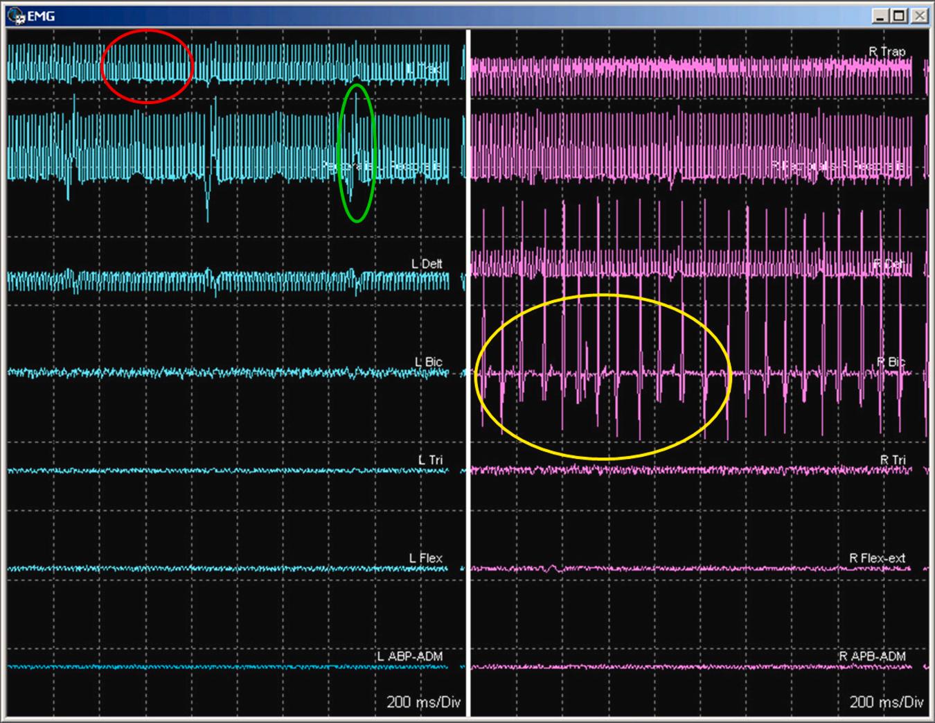 Figure 37.2, Three different wave forms, two of which are artifact. The response in the red circle is artifact from the stimulation device. The response in the green circle is from EKG artifact. The responses in the yellow circle are compound muscle action potentials generated by the antidromic activation of the alpha-motor neuron pool for this muscle group [2] .