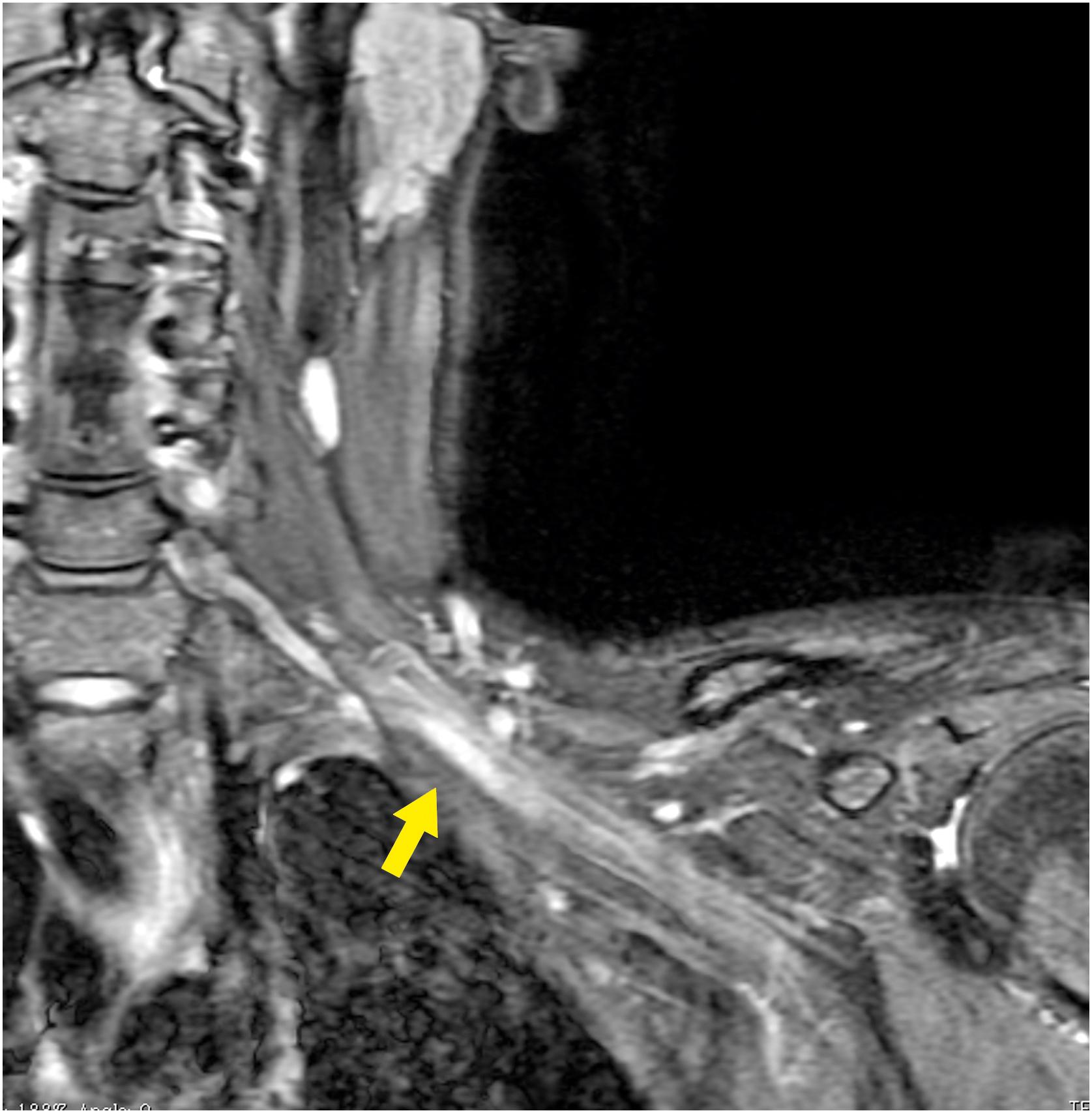 Figure 60-2, Coronal T2-weighted magnetic resonance image (MRI) of the left brachial plexus from the same patient as in Fig. 60-1 . There is increased signal in the left lower trunk ( arrow ), illustrating the usefulness of MRI for localizing nerve trunk lesions.