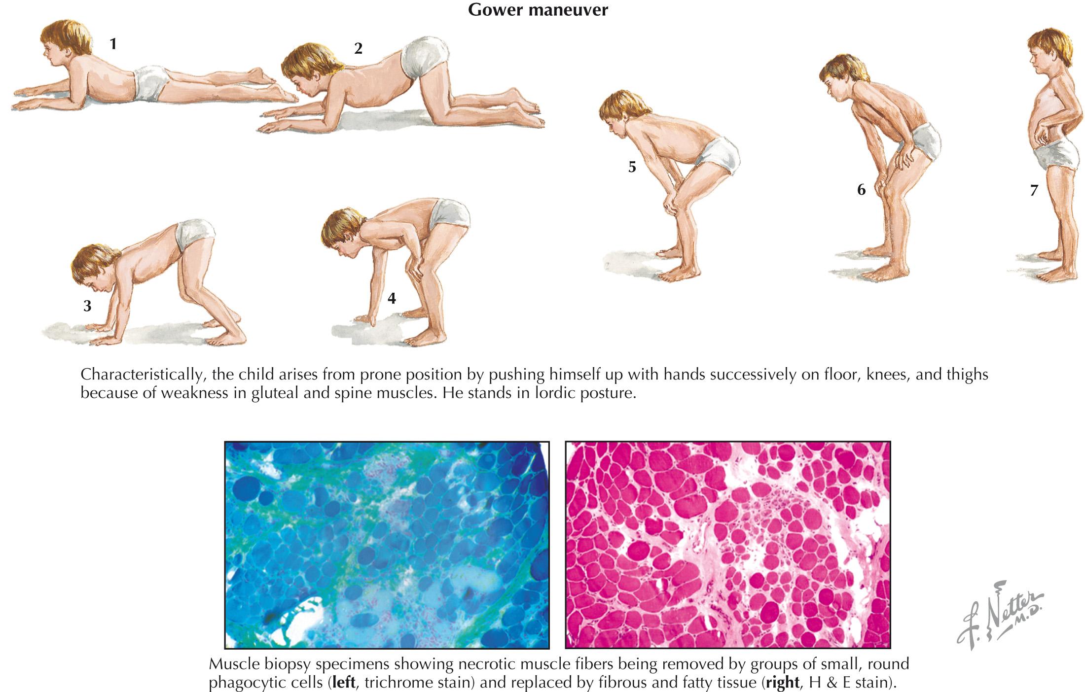 FIG 65.1, Duchenne Muscular Dystrophy.