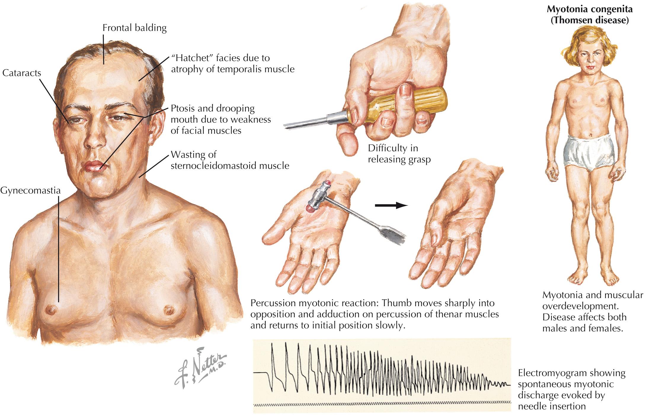 FIG 65.2, Myotonic Dystrophy.