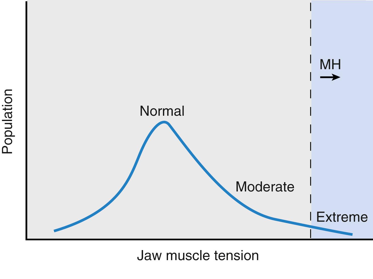 Fig. 35.3, Succinylcholine usually increases jaw muscle tone slightly. In some patients this increase is moderate, and in very few, the effect is extreme (i.e., “jaws of steel”). As many as 50% of this latter group may be susceptible to malignant hyperthermia (MH) . Somewhere in the area of the declining curve is the boundary for the MH population.