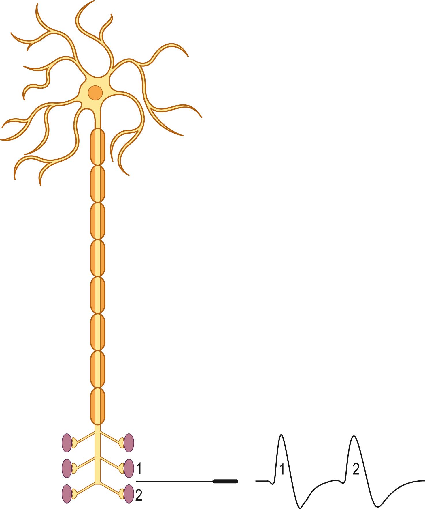 Fig. 37.2, Single-fiber electromyography (SF-EMG).